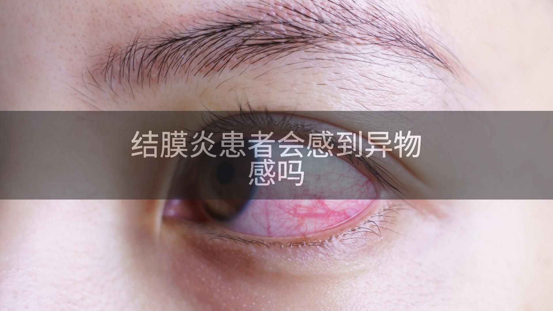 结膜炎患者会感到异物感吗