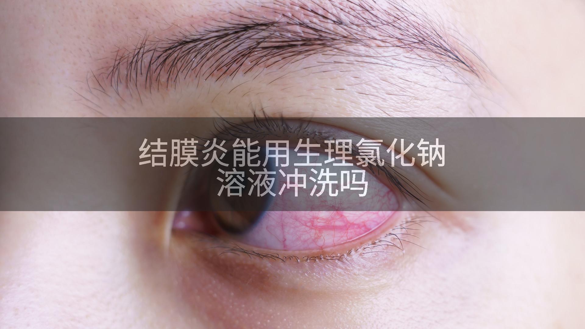 结膜炎能用生理氯化钠溶液冲洗吗