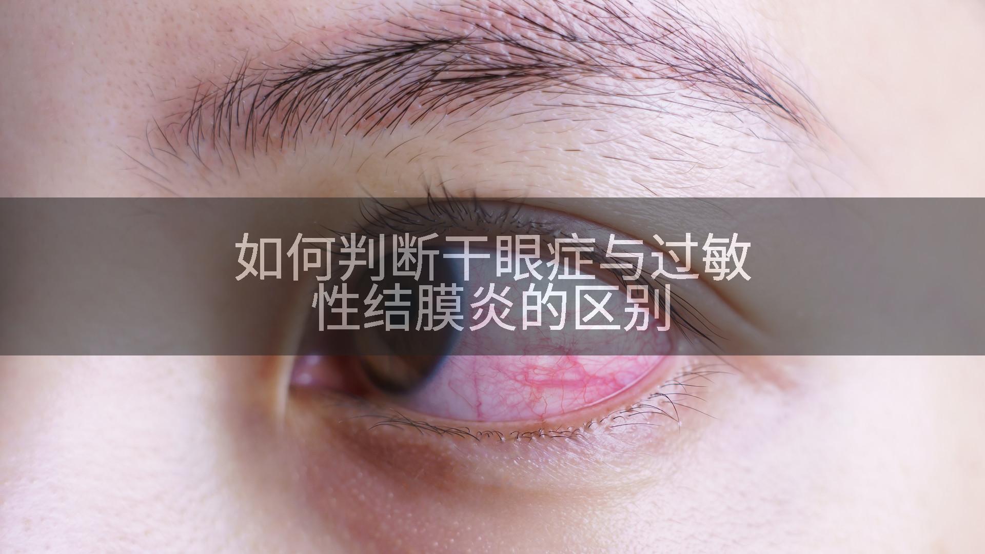 如何判断干眼症与过敏性结膜炎的区别