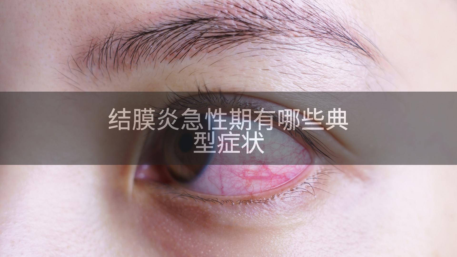 结膜炎急性期有哪些典型症状