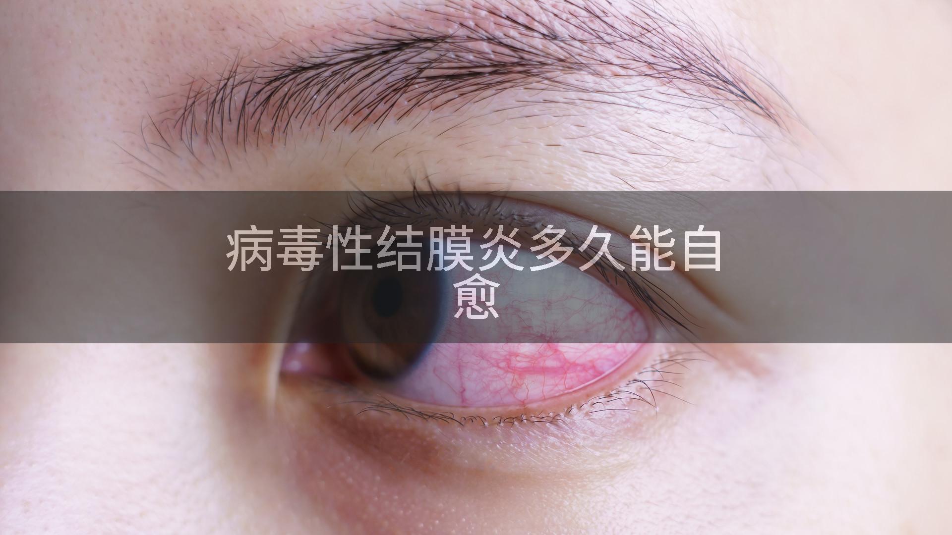病毒性结膜炎多久能自愈