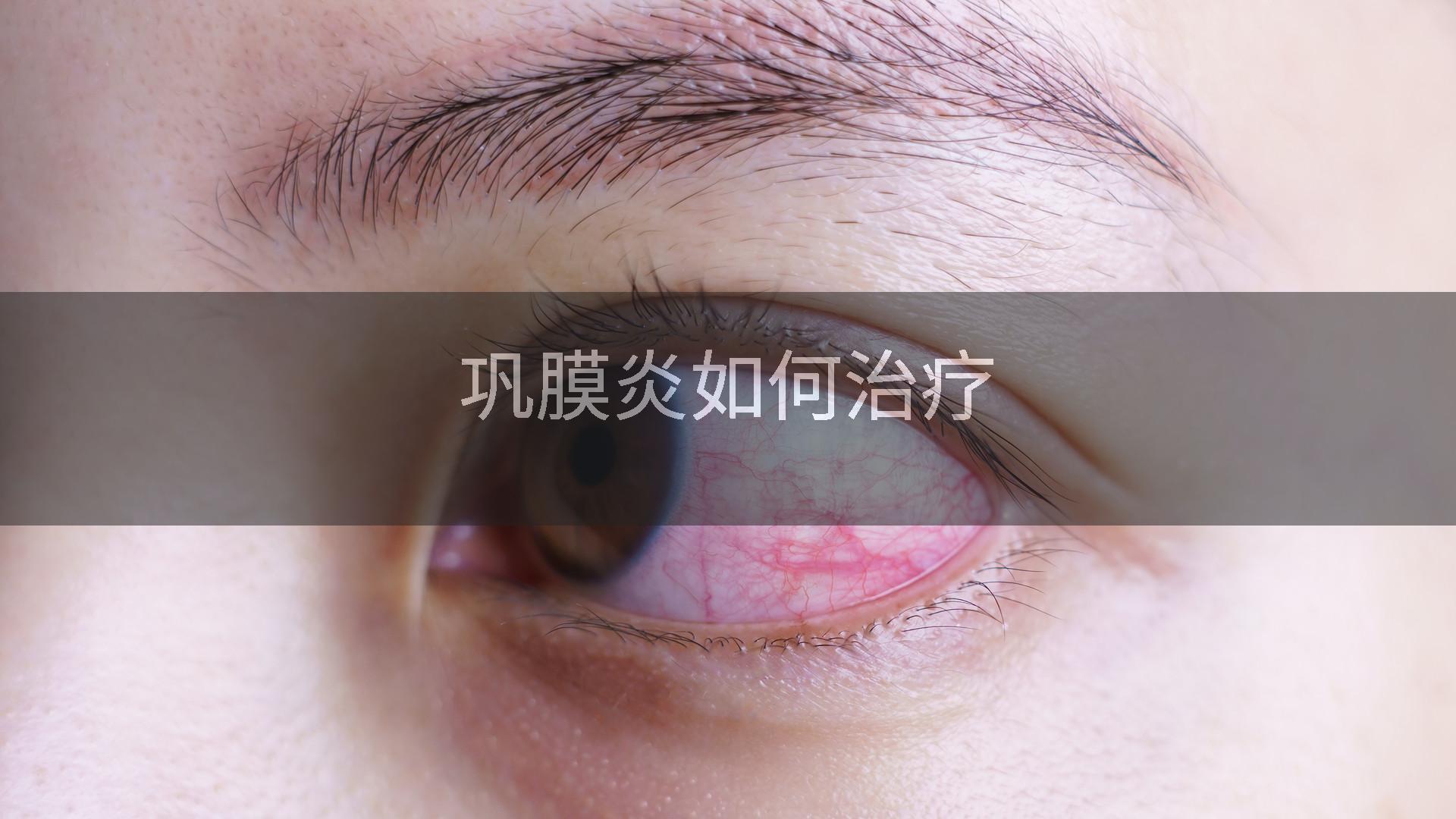 巩膜炎如何治疗