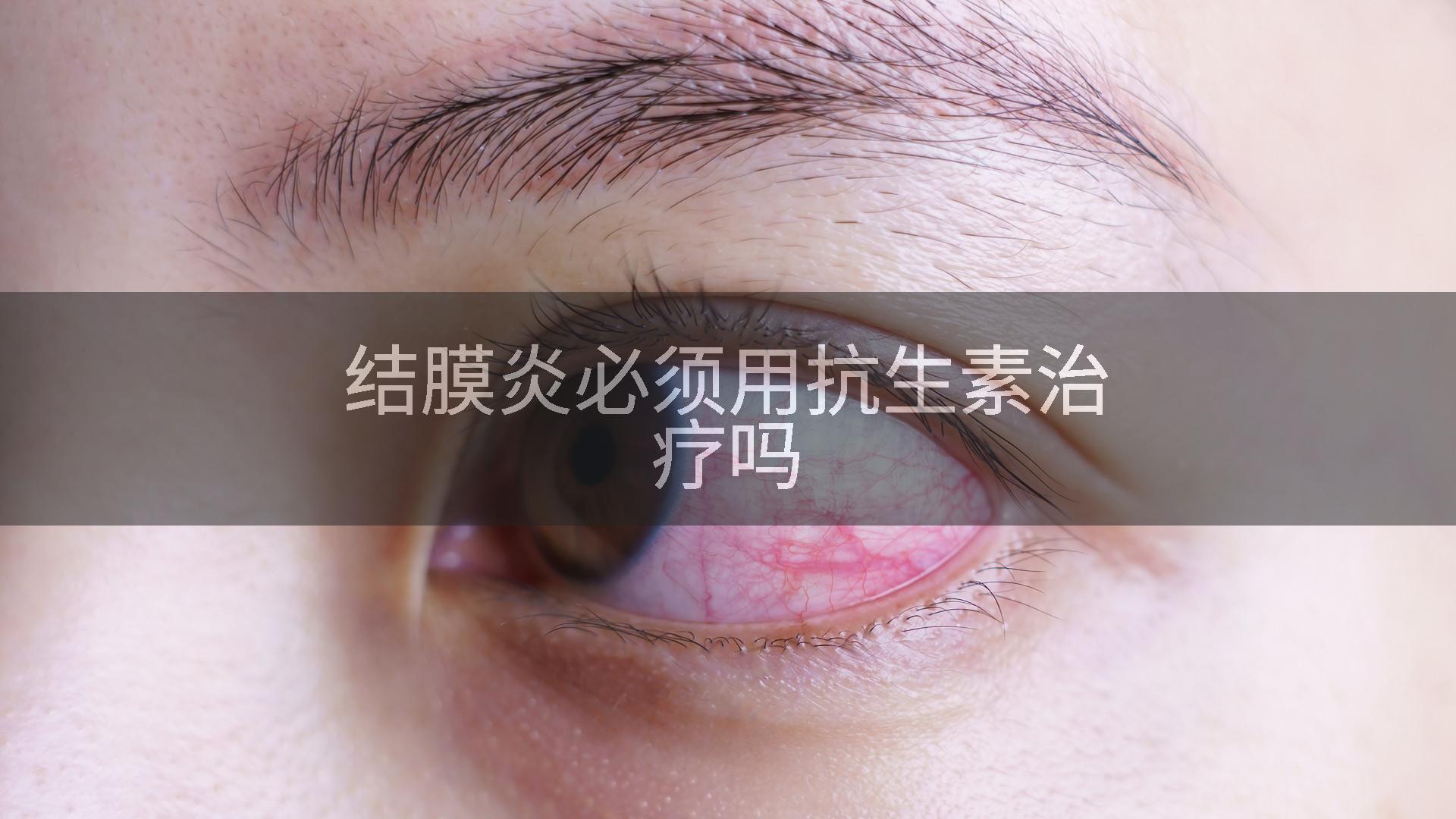 结膜炎必须用抗生素治疗吗