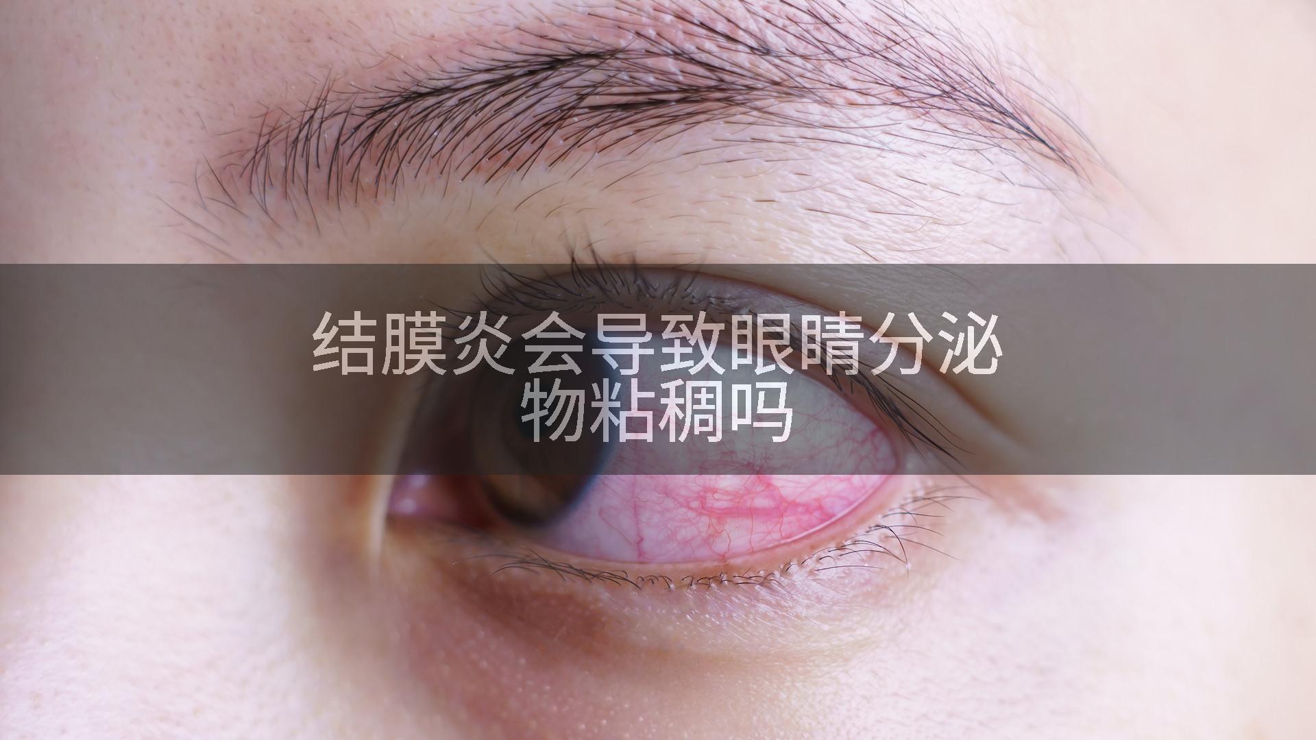 结膜炎会导致眼睛分泌物粘稠吗