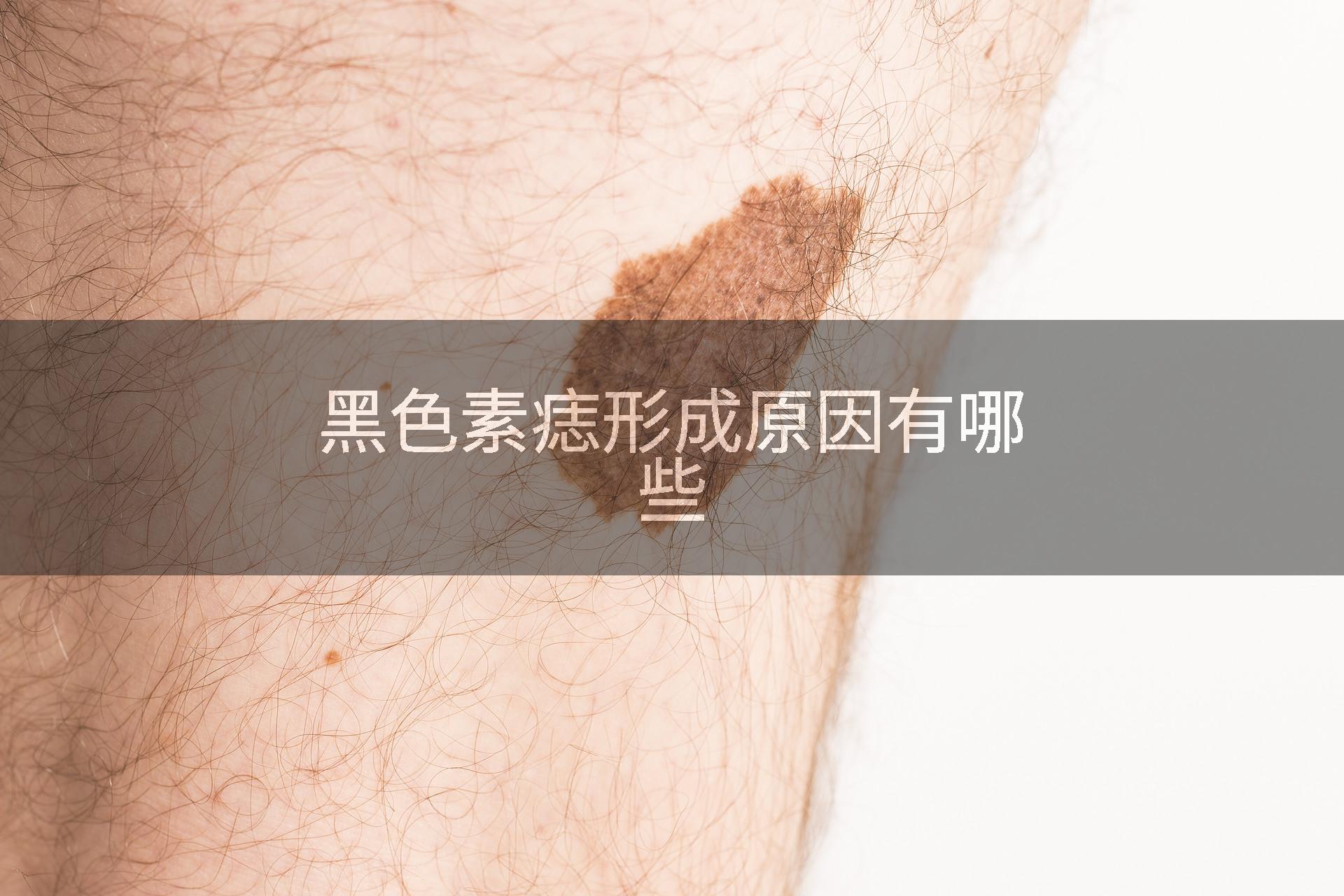 黑色素痣形成原因有哪些