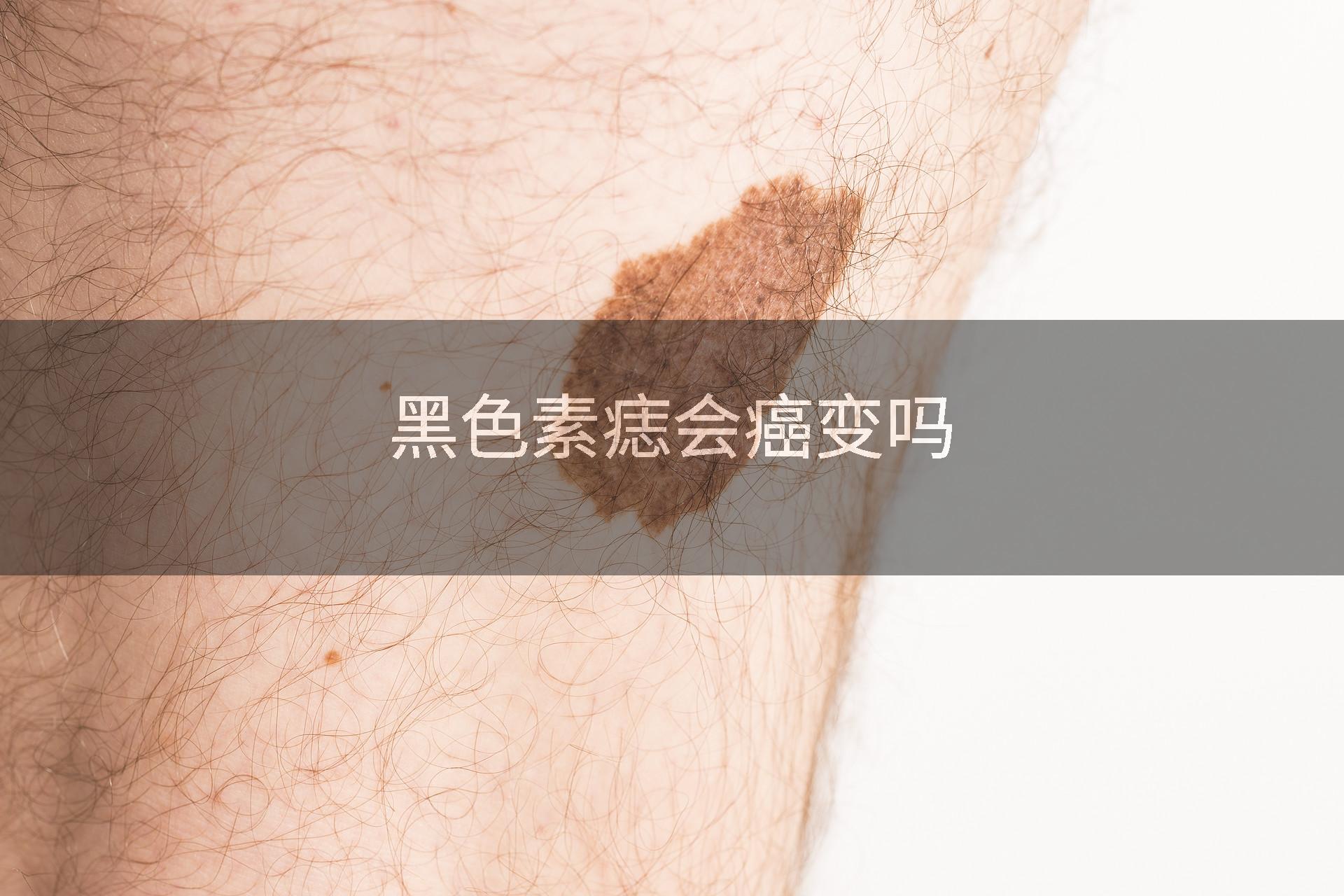 黑色素痣会癌变吗