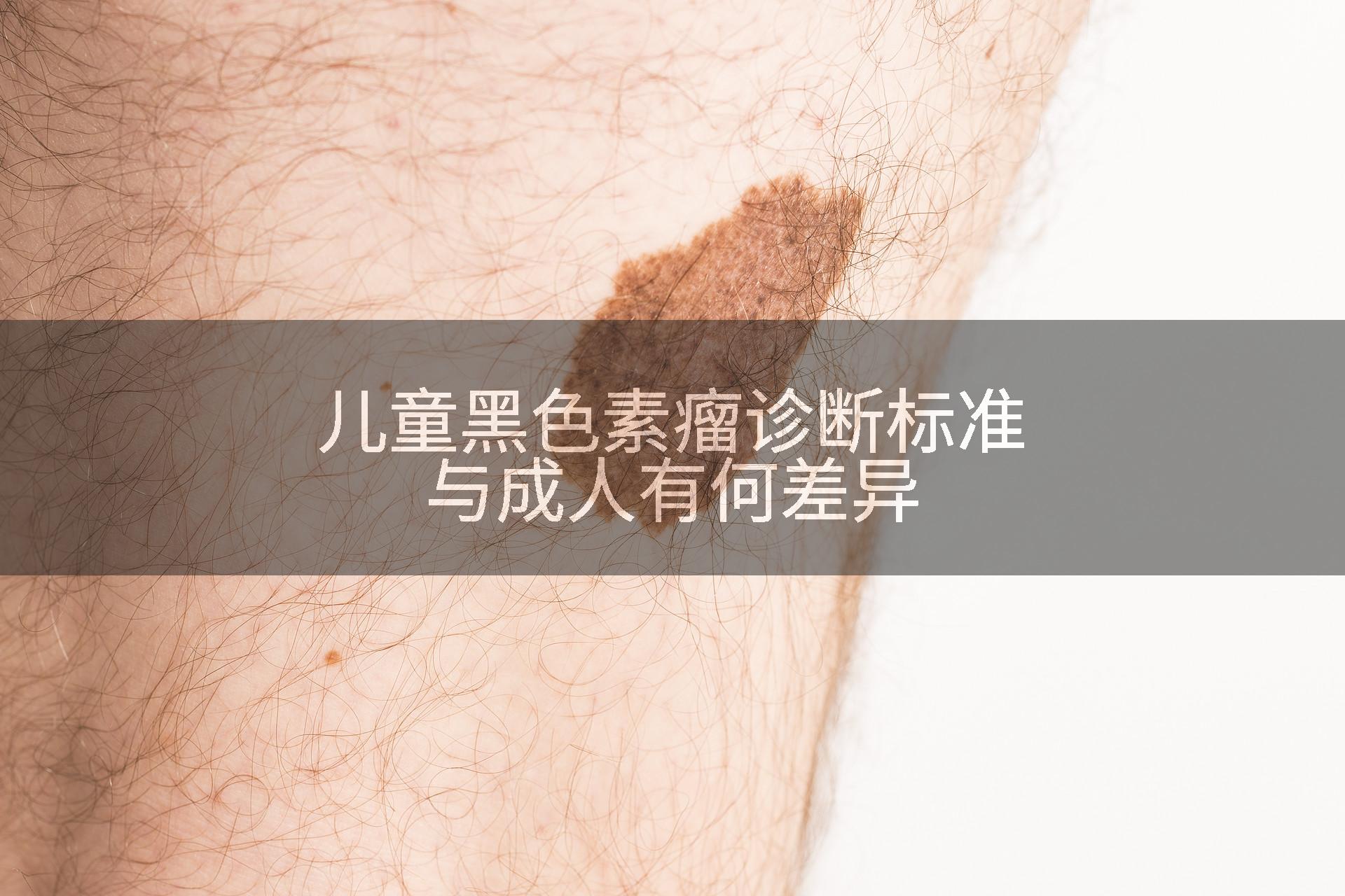 儿童黑色素瘤诊断标准与成人有何差异