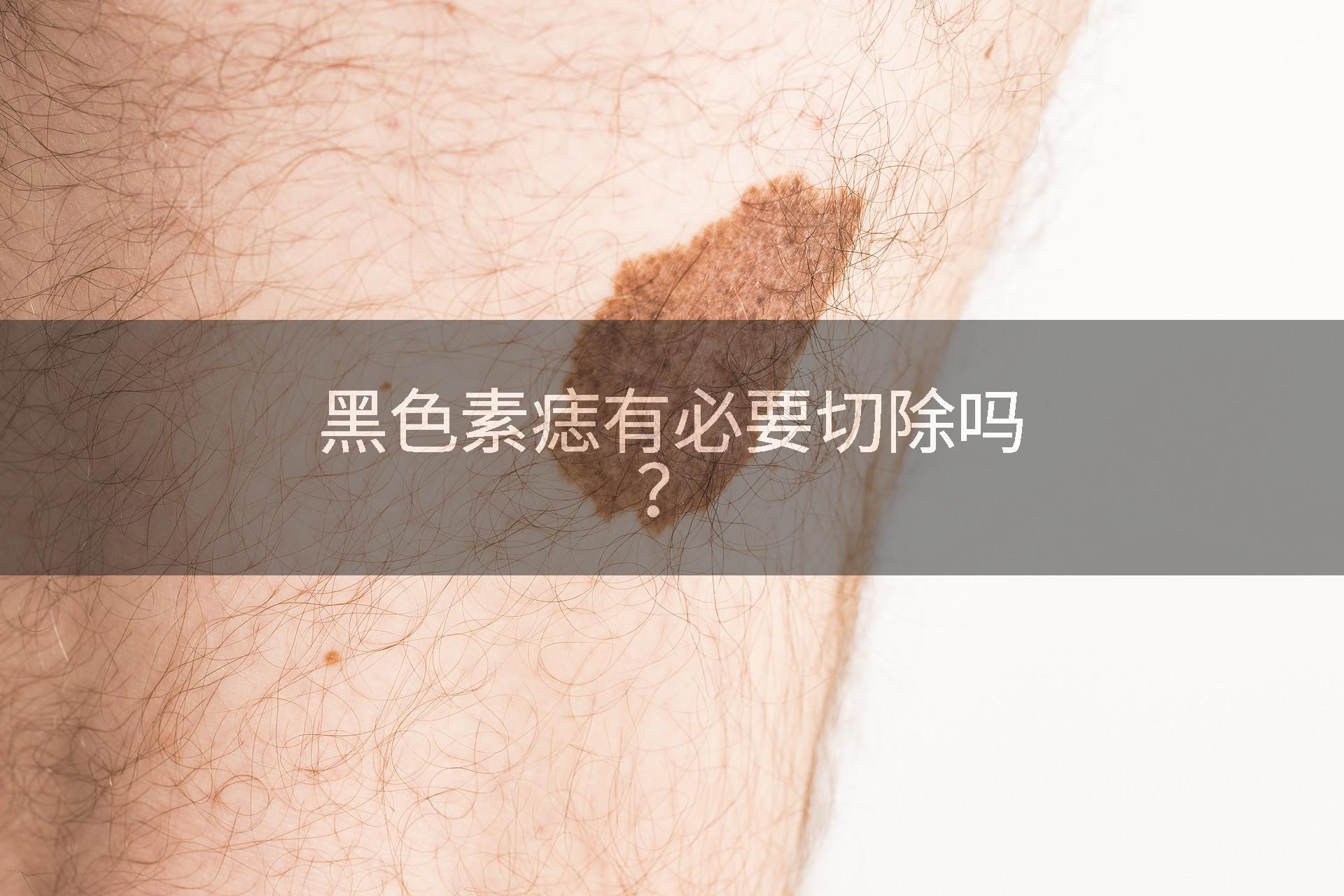 黑色素痣有必要切除吗？
