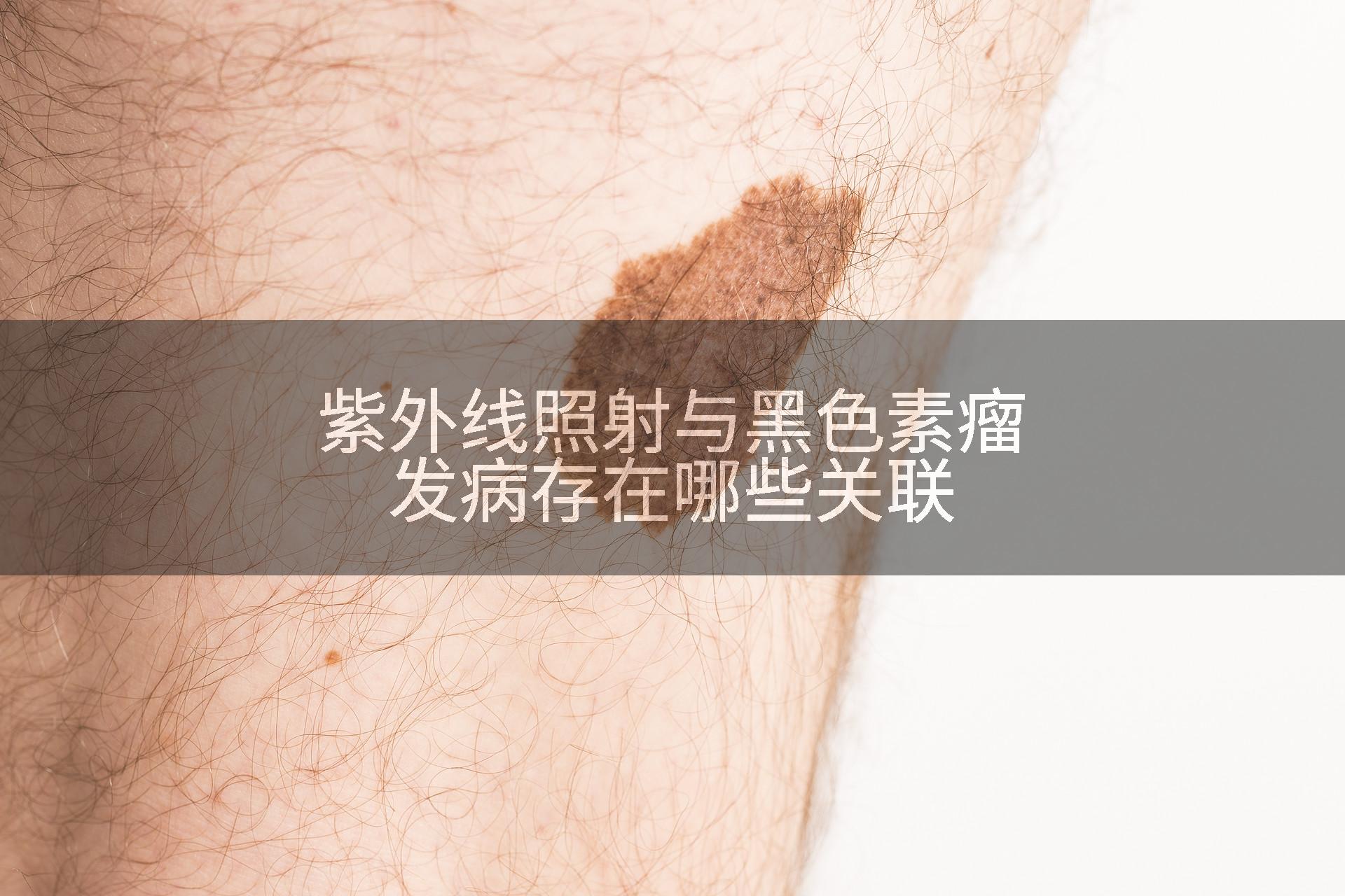 紫外线照射与黑色素瘤发病存在哪些关联