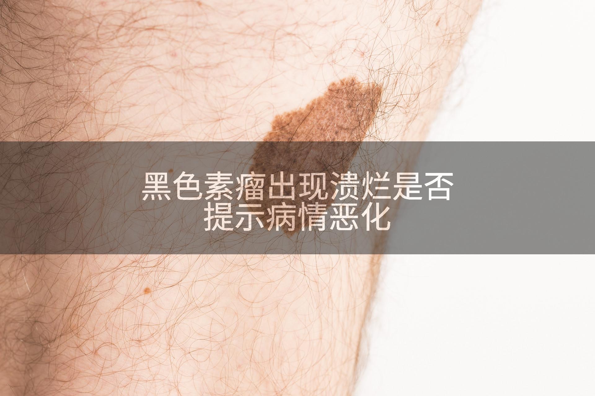 黑色素瘤出现溃烂是否提示病情恶化