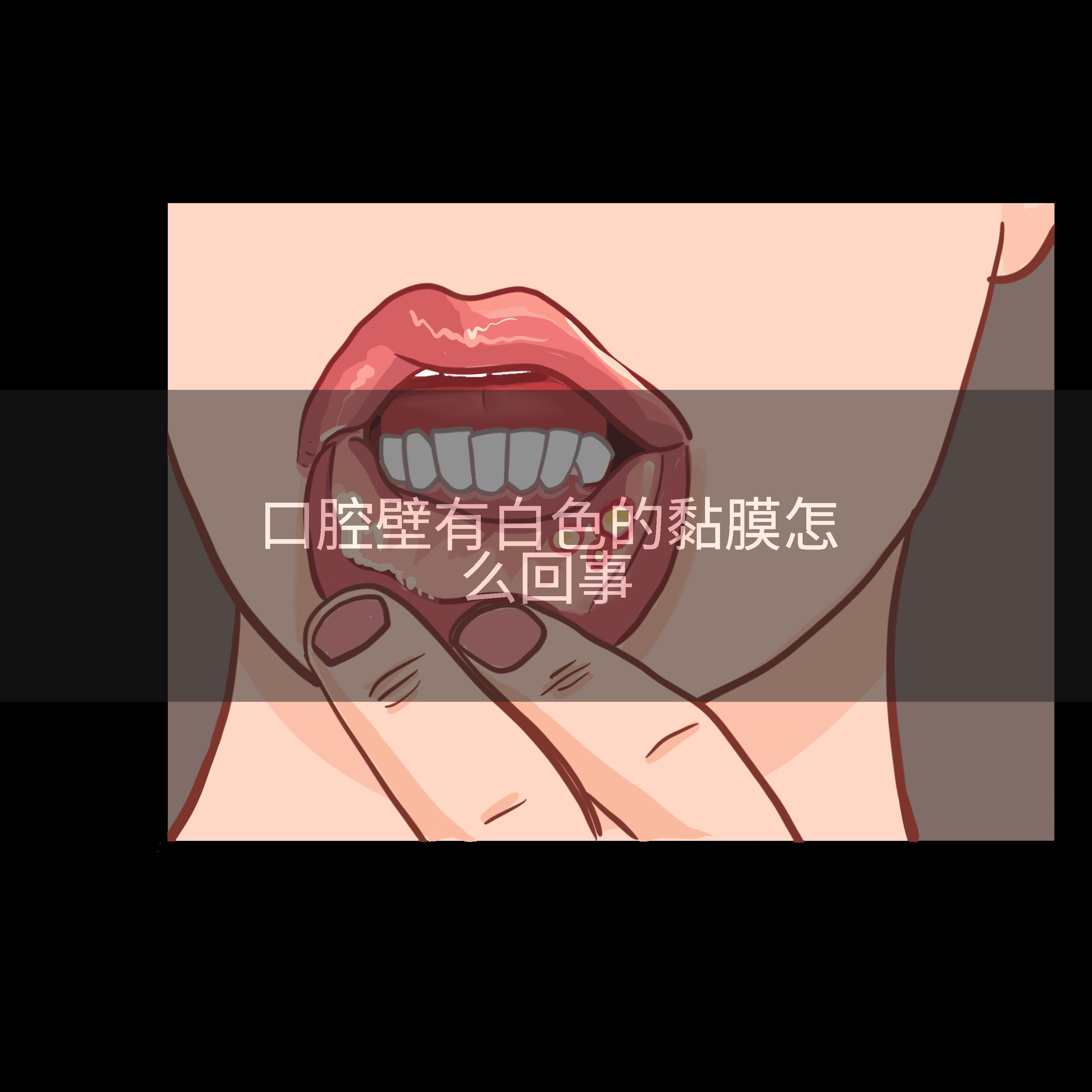 口腔壁有白色的黏膜怎么回事