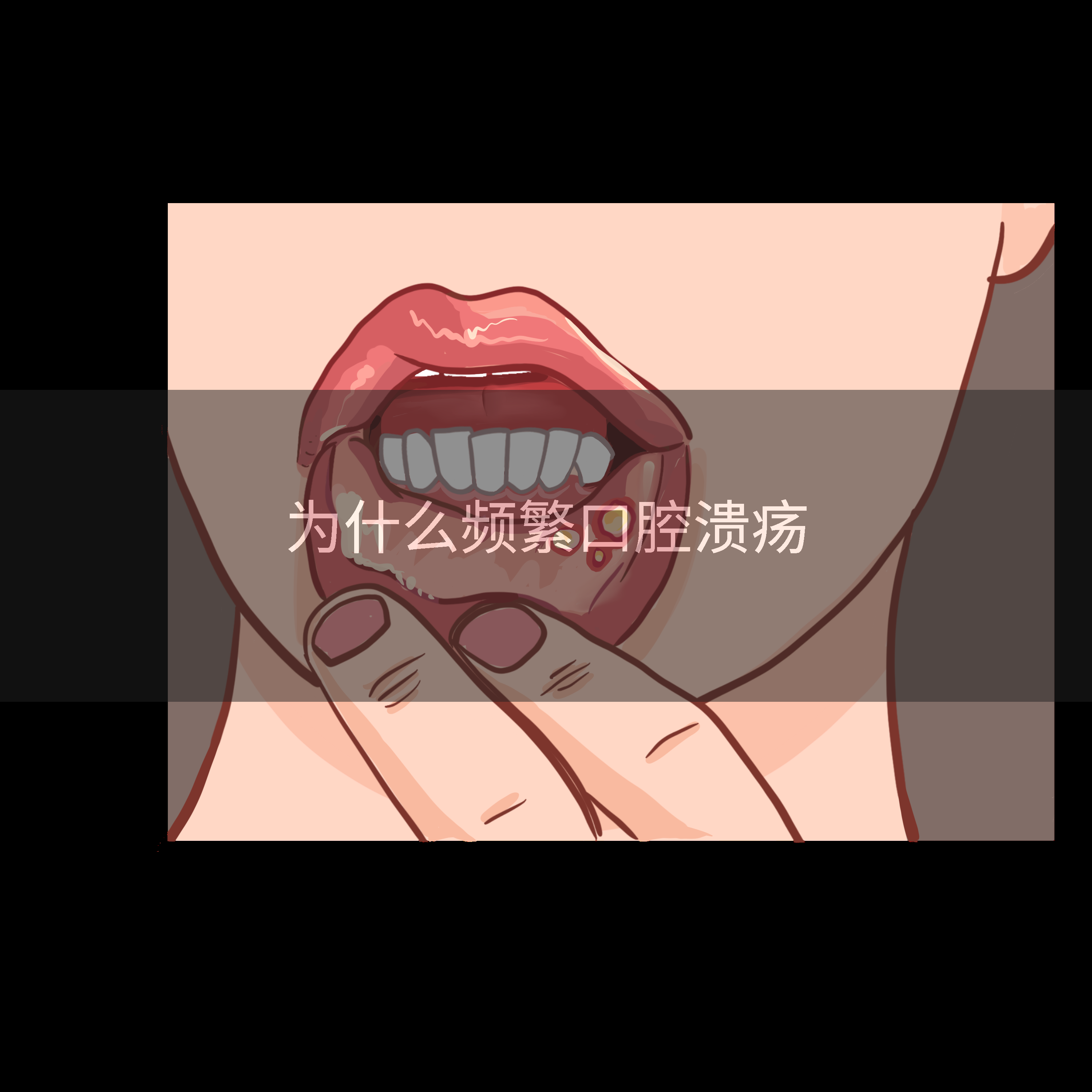 为什么频繁口腔溃疡