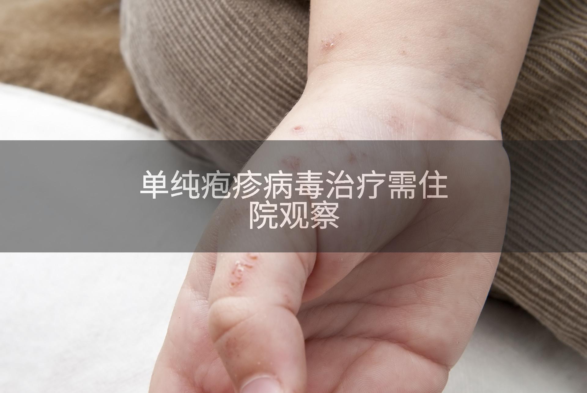 单纯疱疹病毒治疗需住院观察
