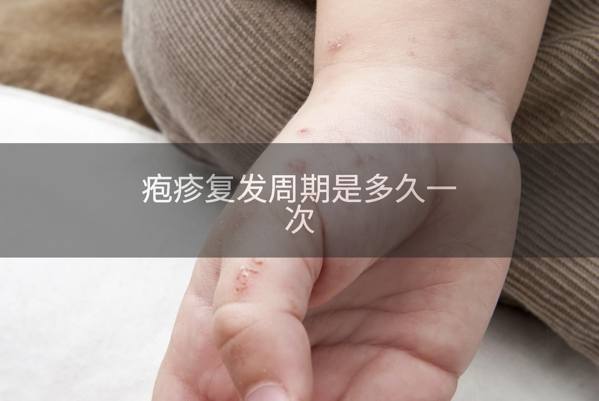 疱疹复发周期是多久一次
