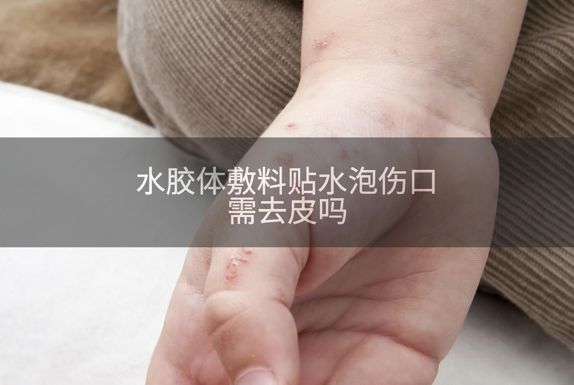 水胶体敷料贴水泡伤口需去皮吗