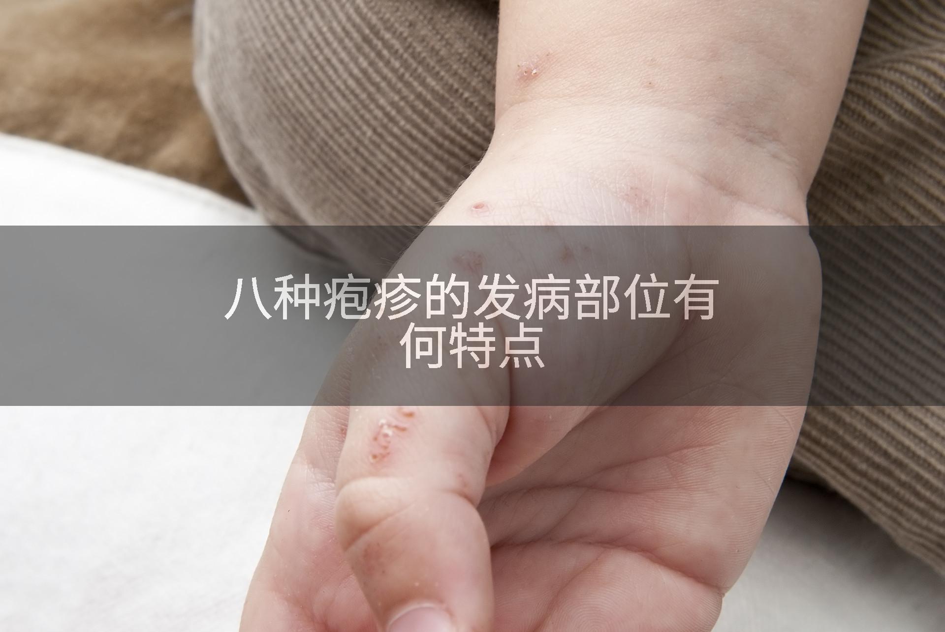 八种疱疹的发病部位有何特点