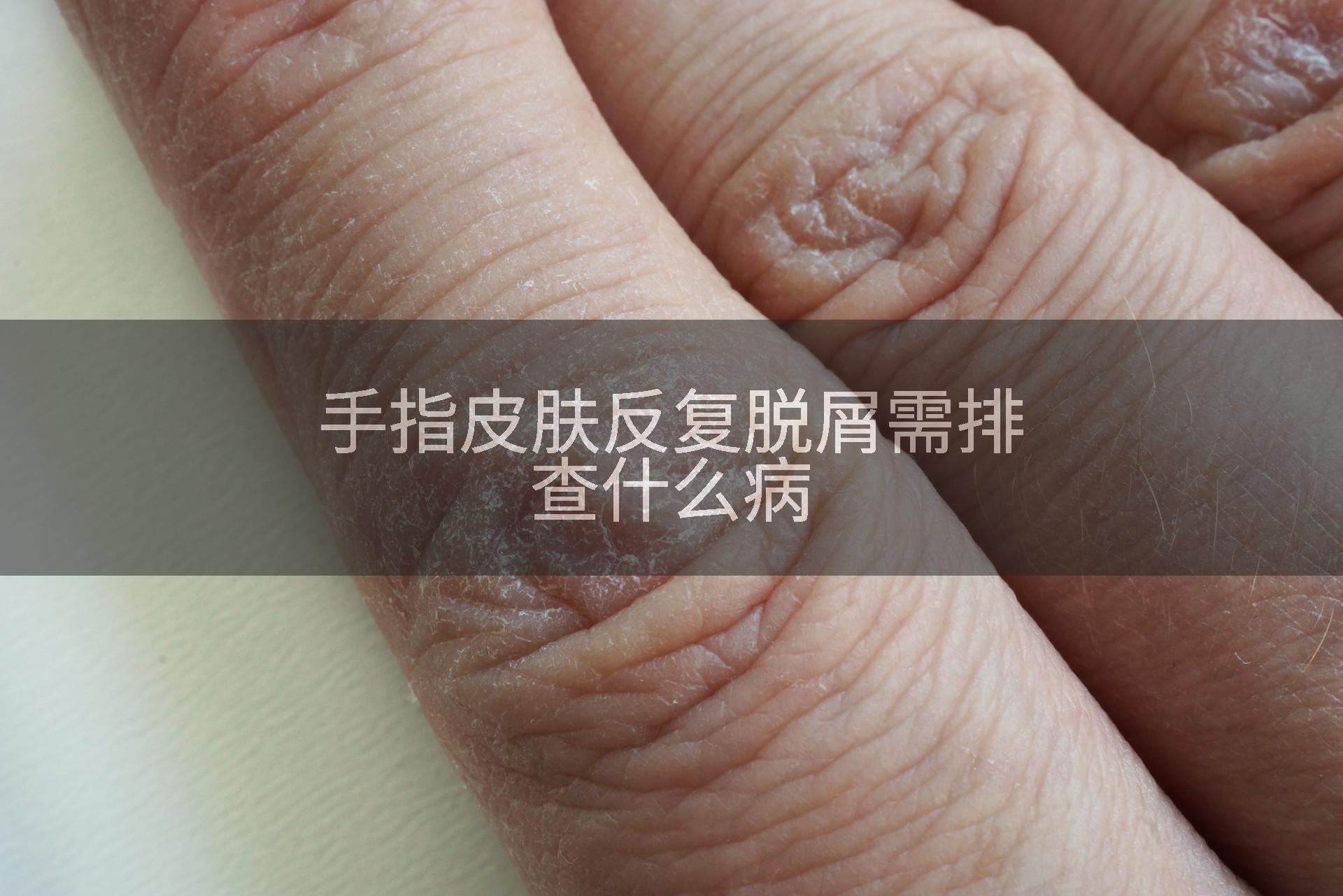 手指皮肤反复脱屑需排查什么病