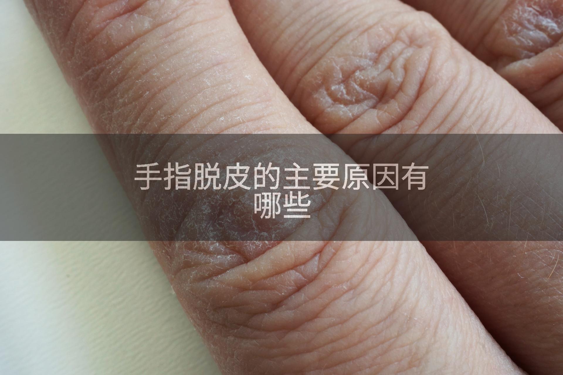 手指脱皮的主要原因有哪些