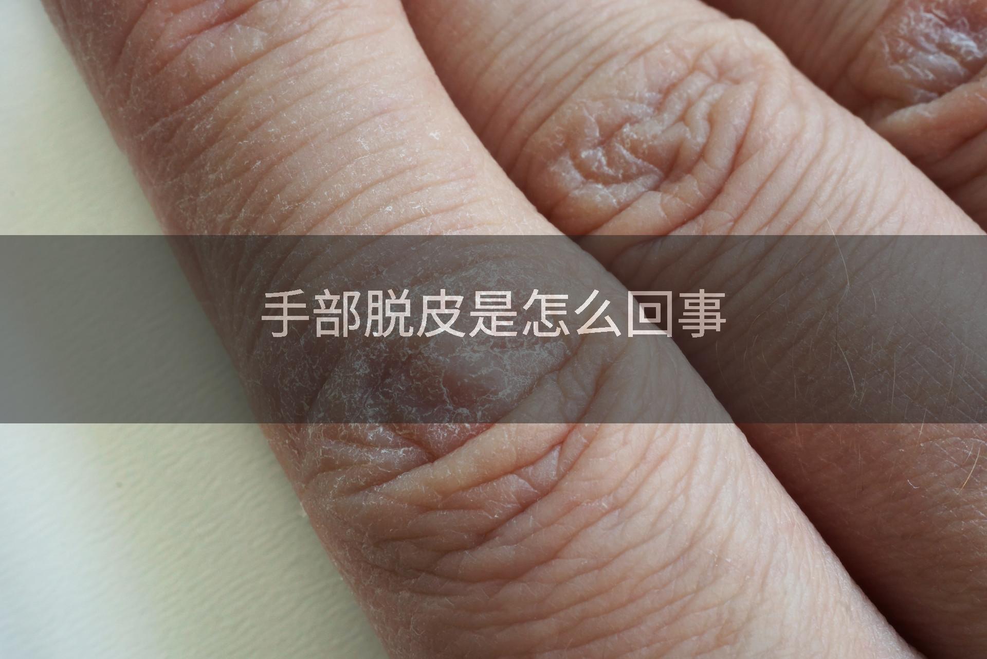 手部脱皮是怎么回事