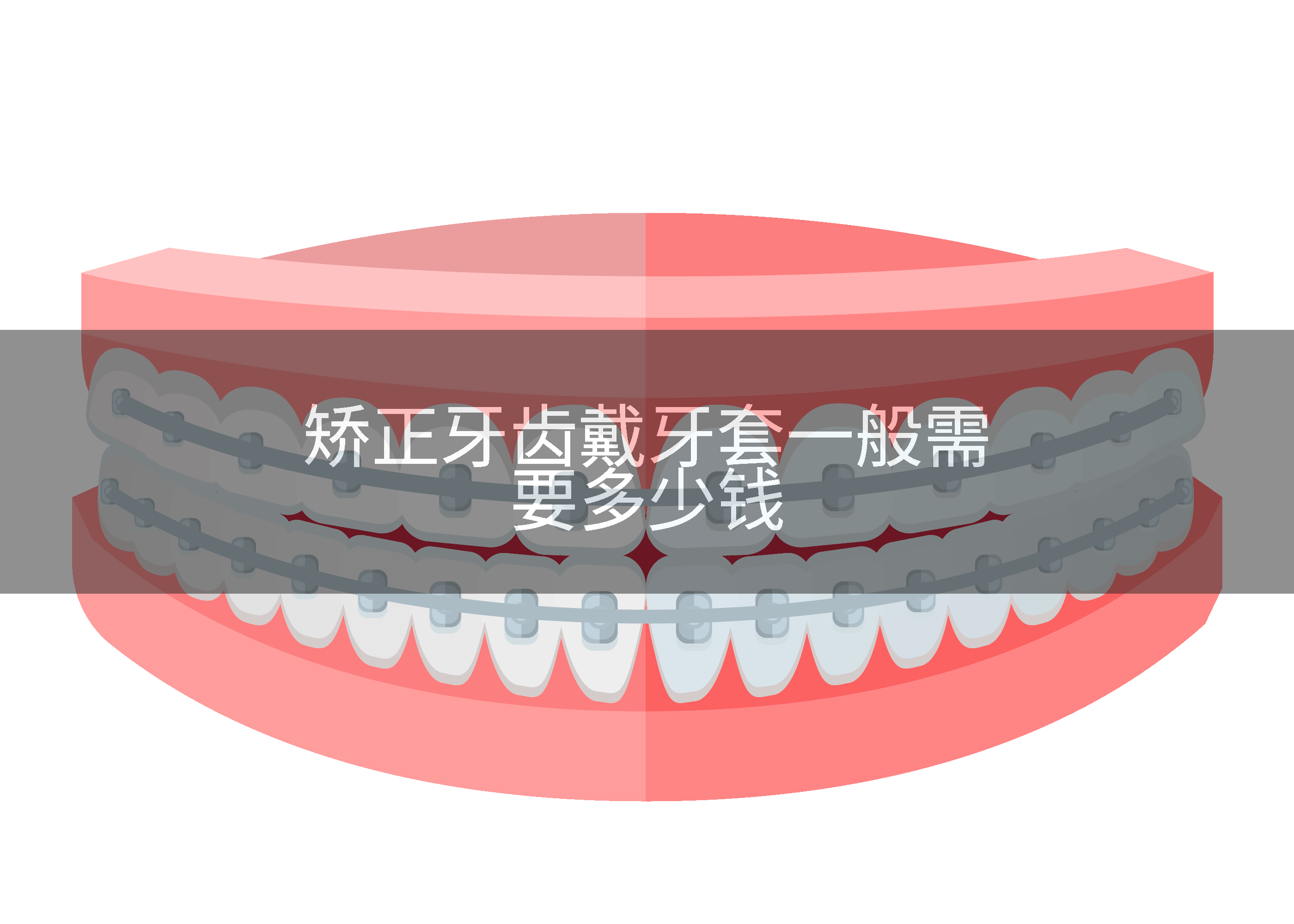 矫正牙齿戴牙套一般需要多少钱