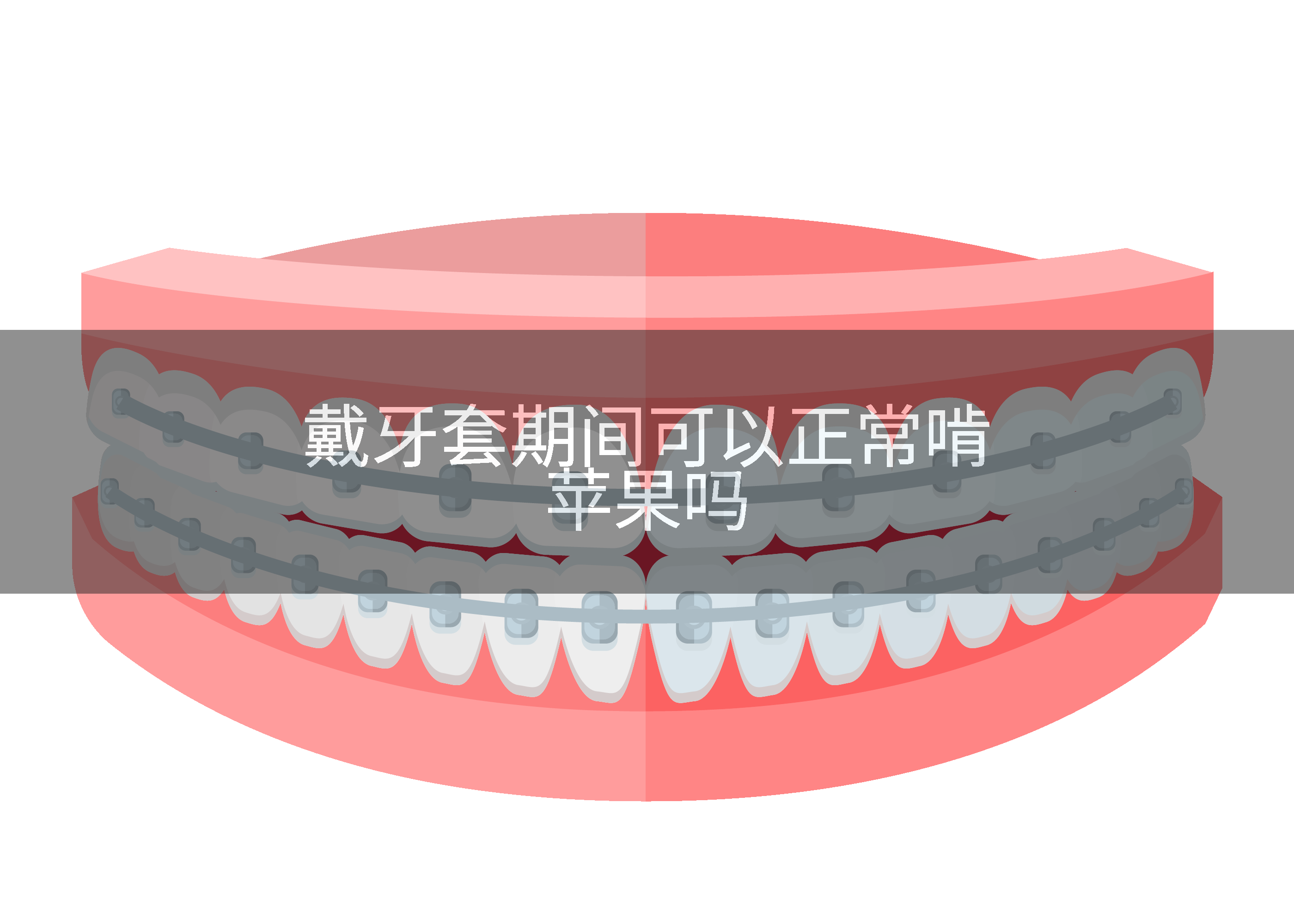 戴牙套期间可以正常啃苹果吗