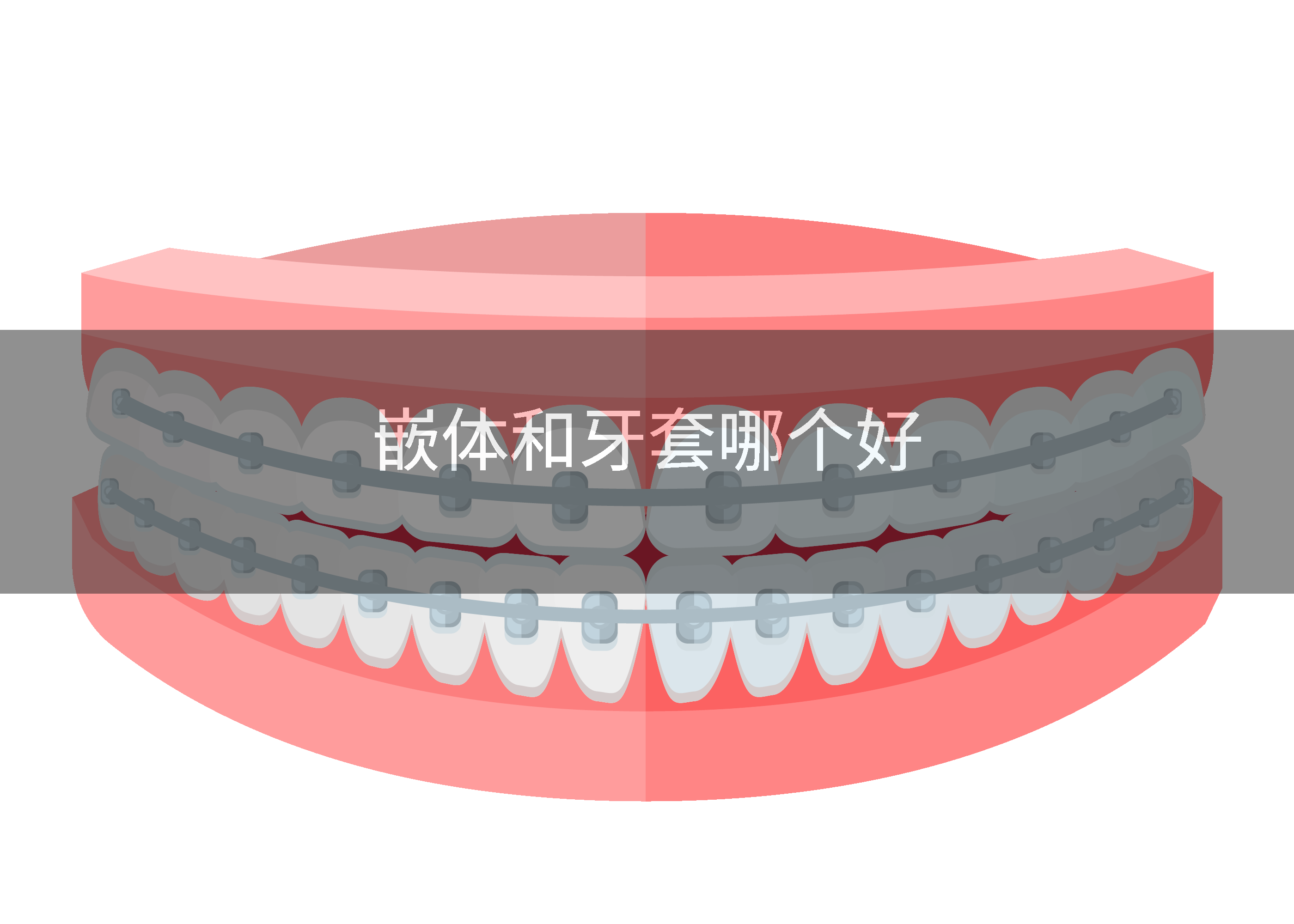 嵌体和牙套哪个好