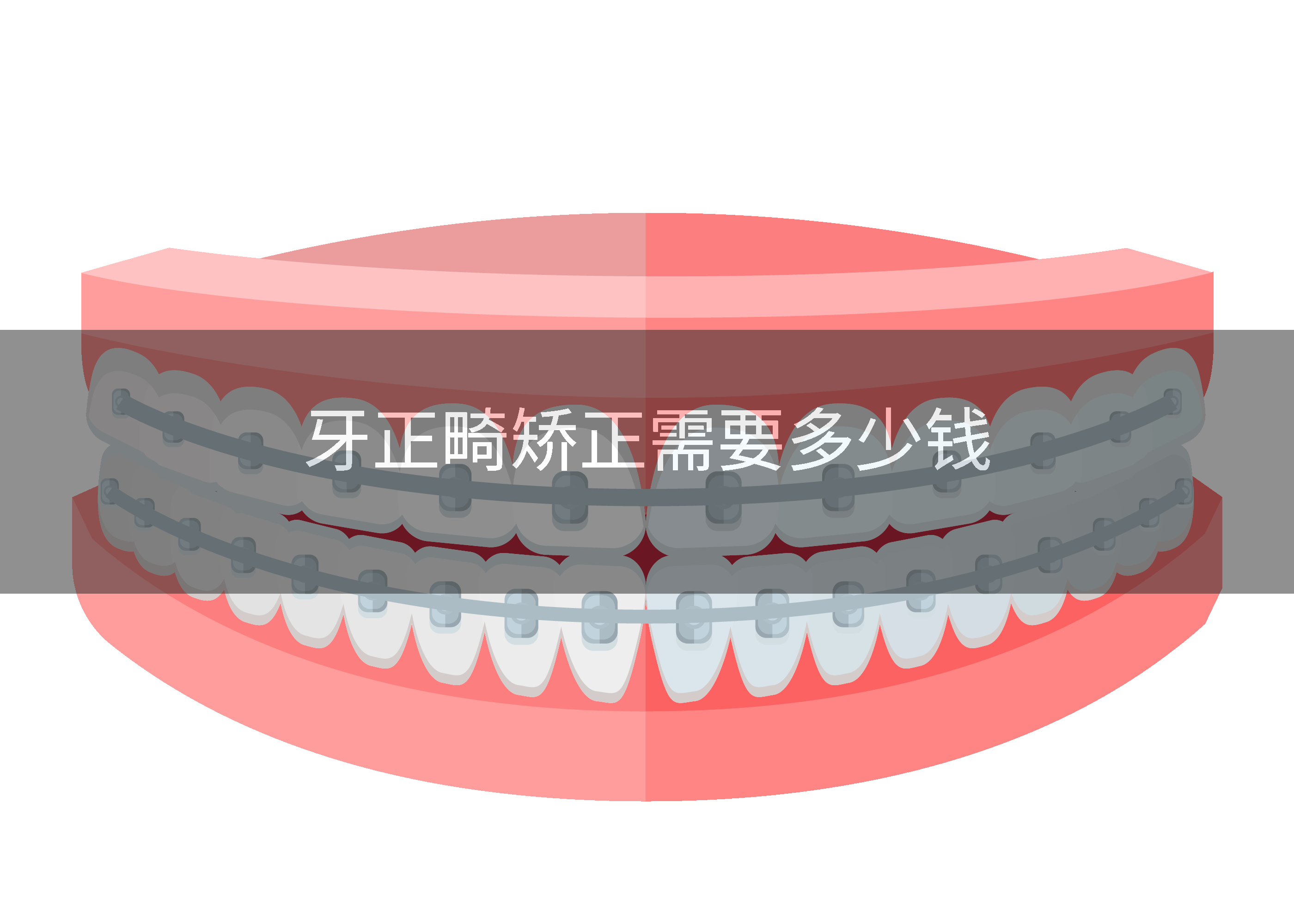 牙正畸矫正需要多少钱