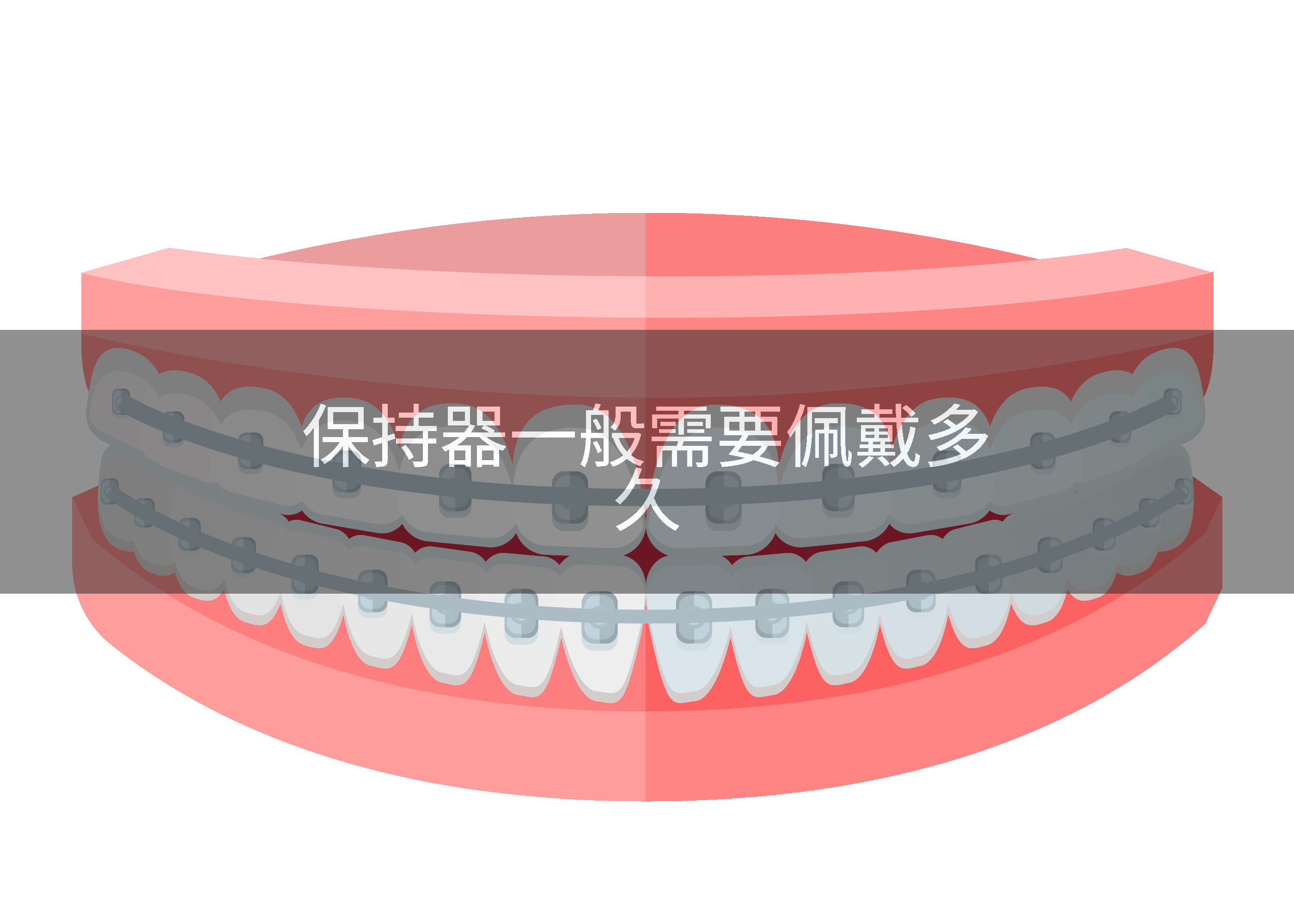 保持器一般需要佩戴多久