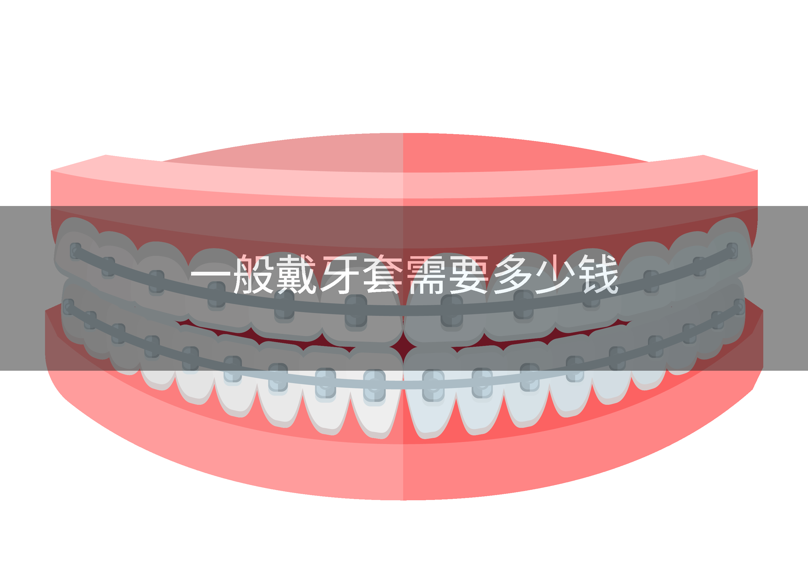 一般戴牙套需要多少钱