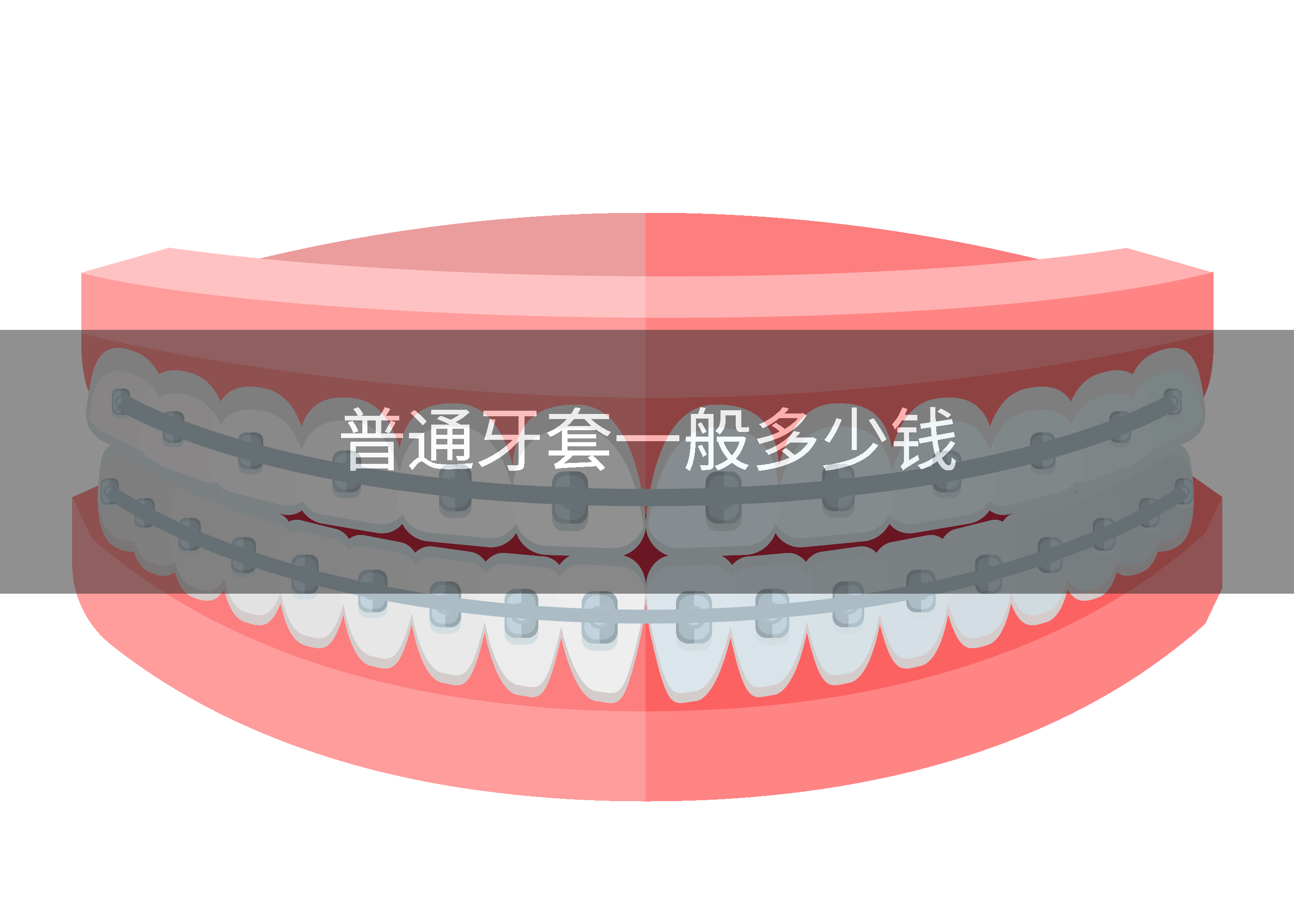 普通牙套一般多少钱