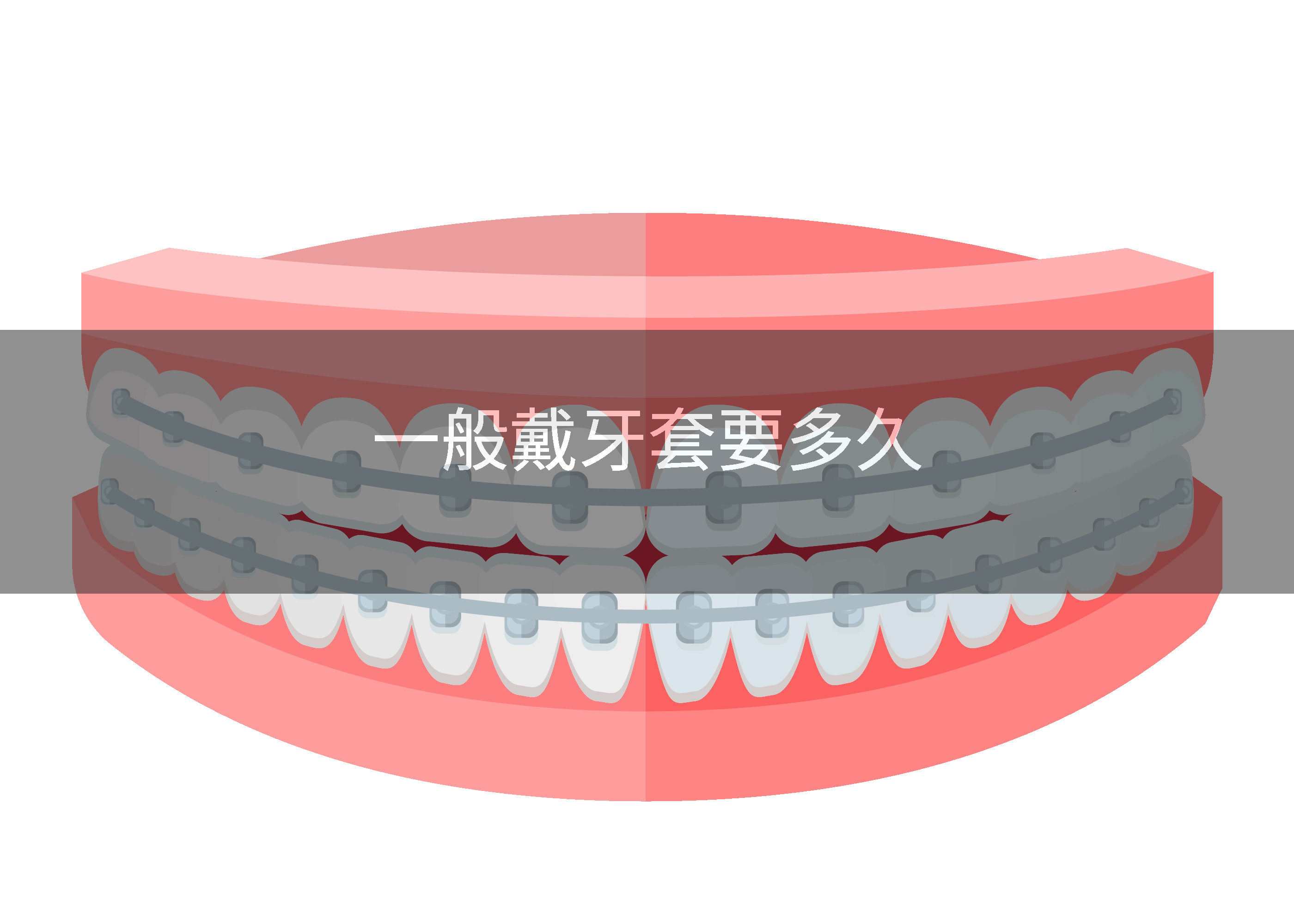 一般戴牙套要多久