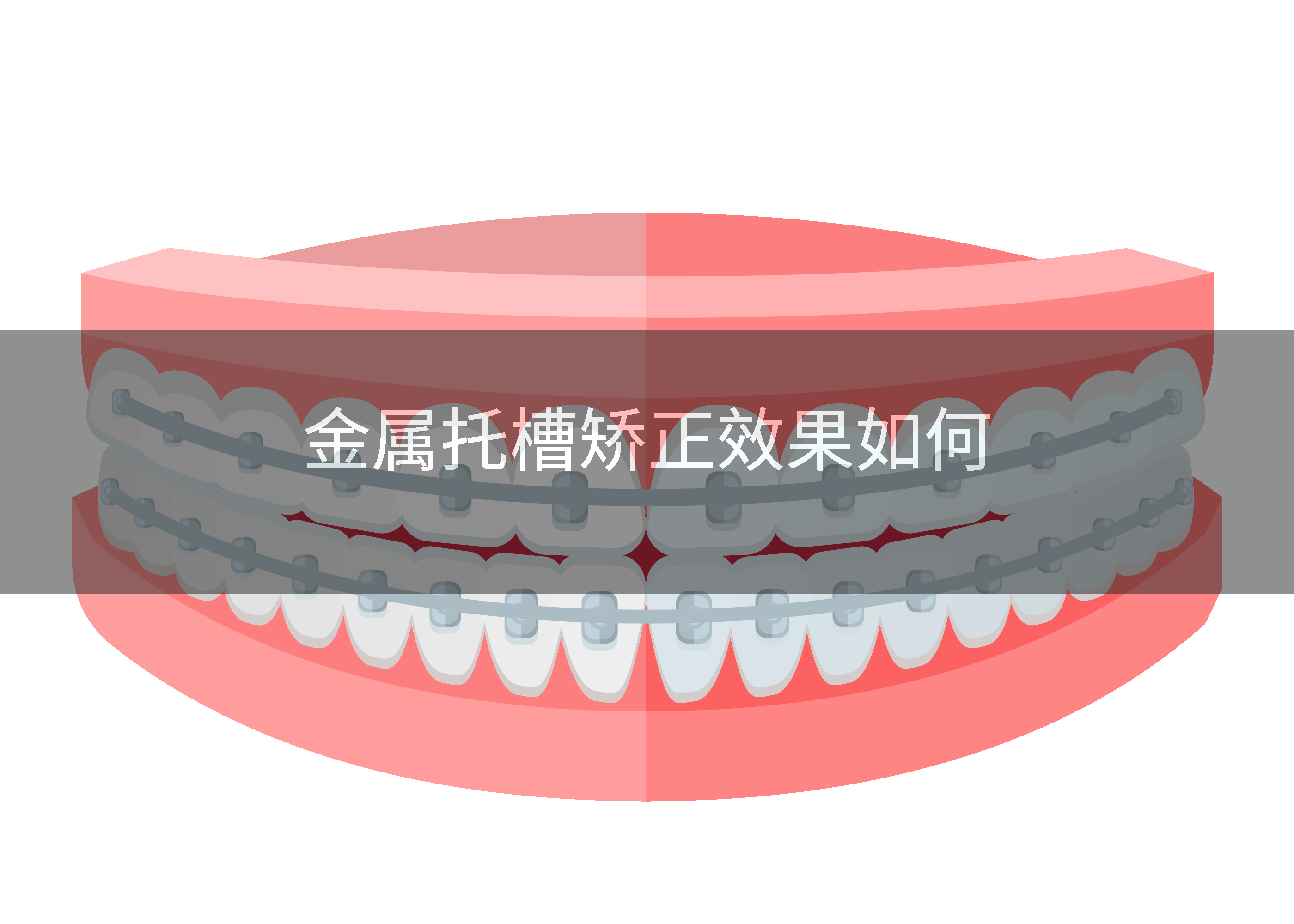 金属托槽矫正效果如何