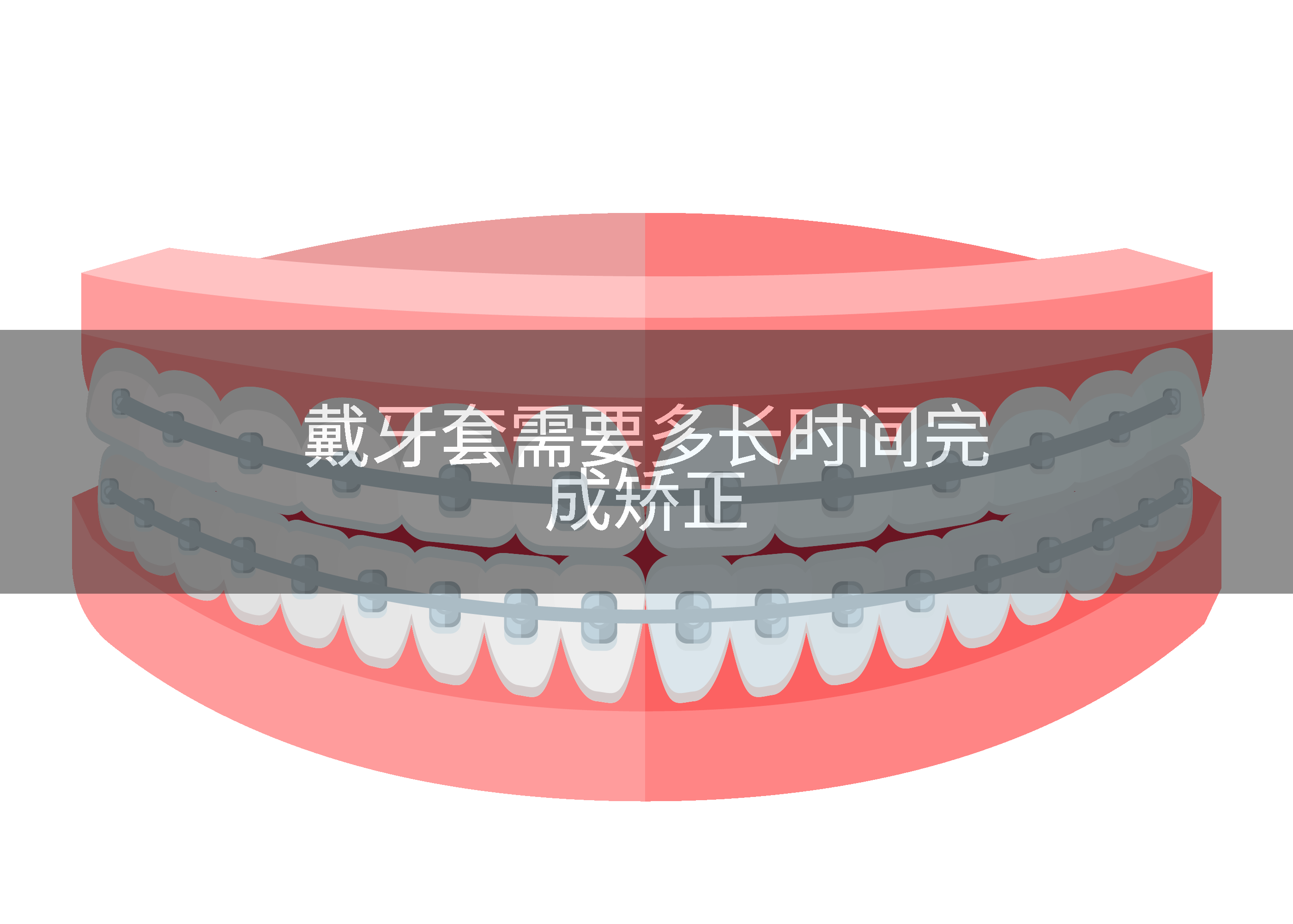 戴牙套需要多长时间完成矫正