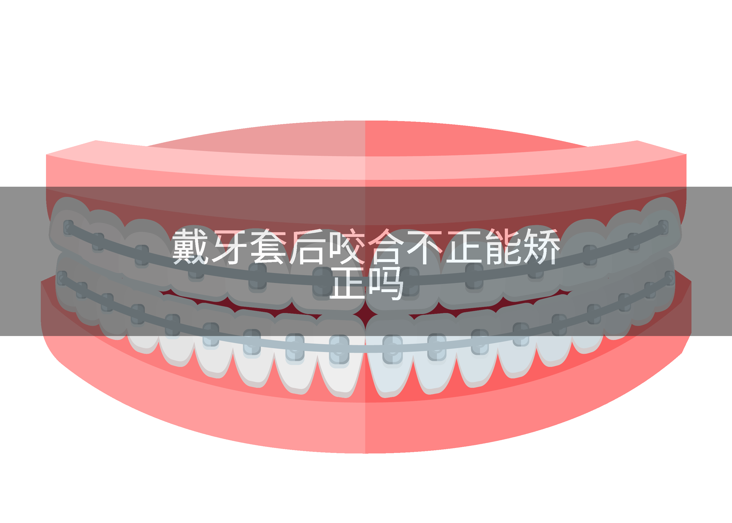 戴牙套后咬合不正能矫正吗