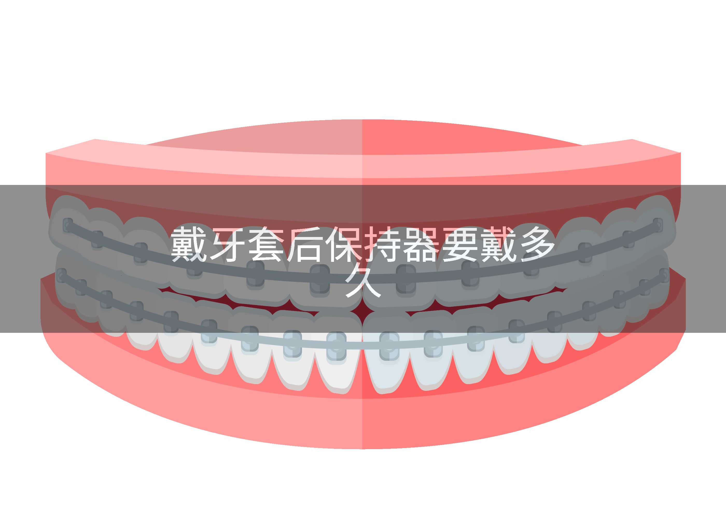 戴牙套后保持器要戴多久