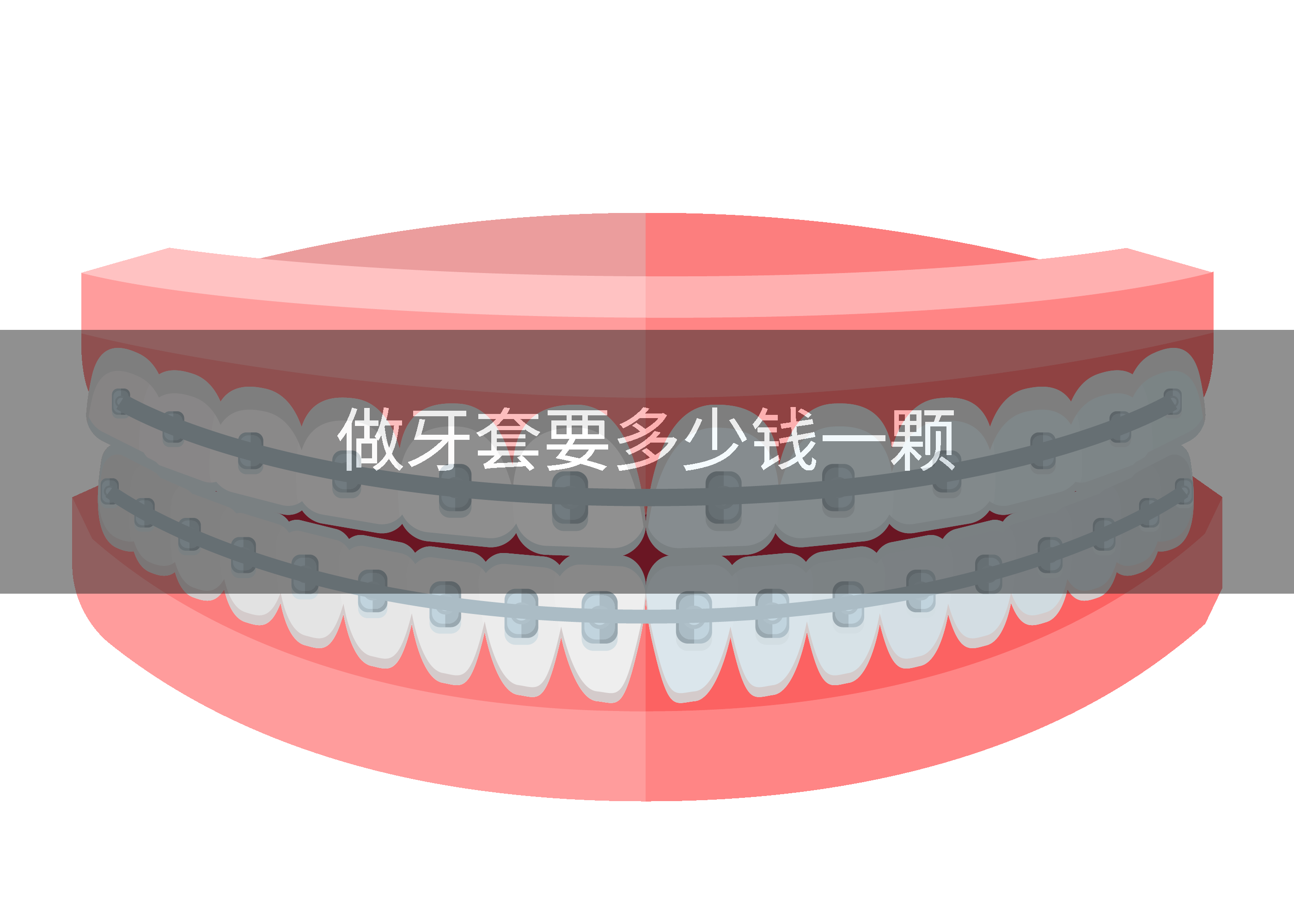 做牙套要多少钱一颗