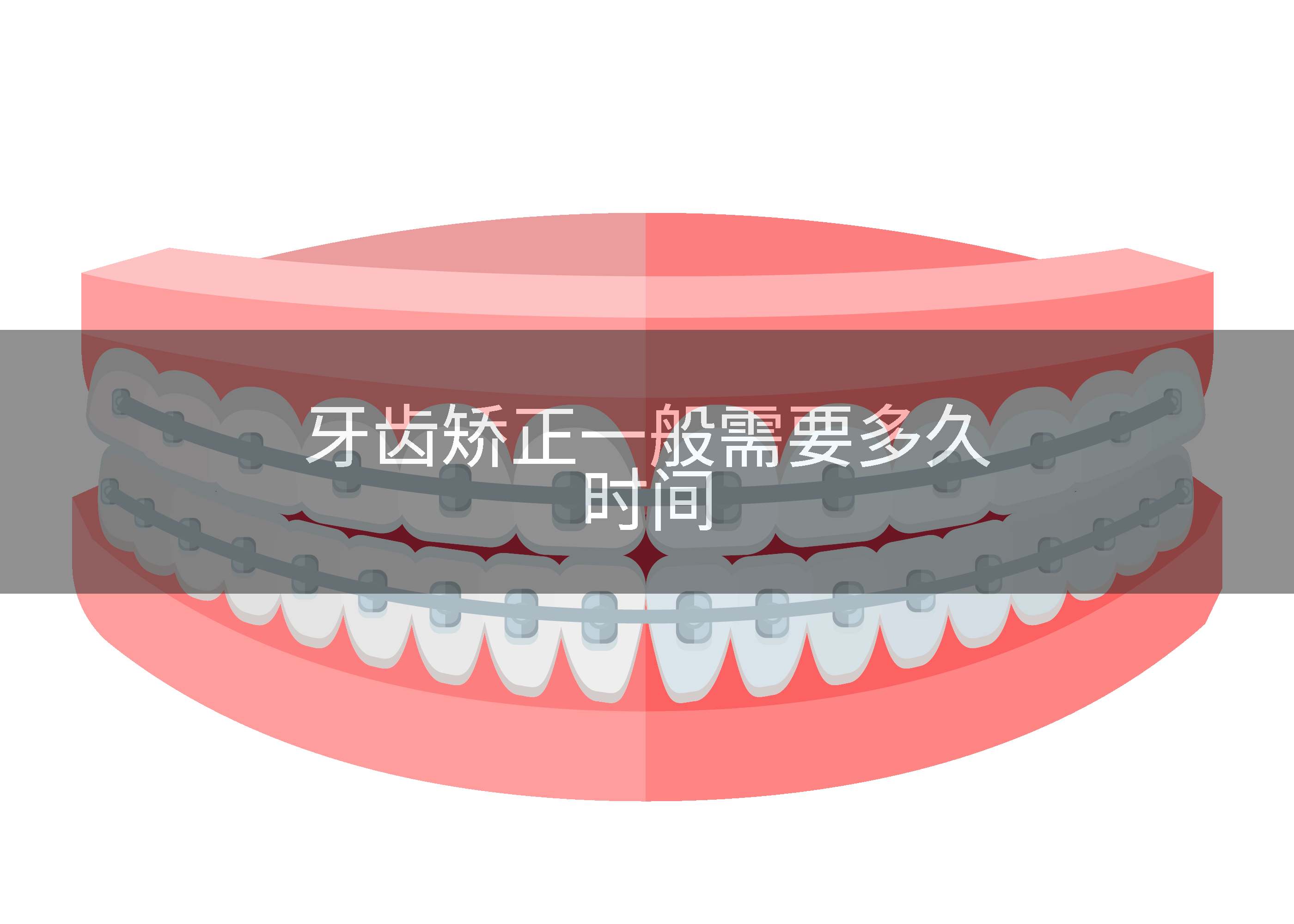牙齿矫正一般需要多久时间