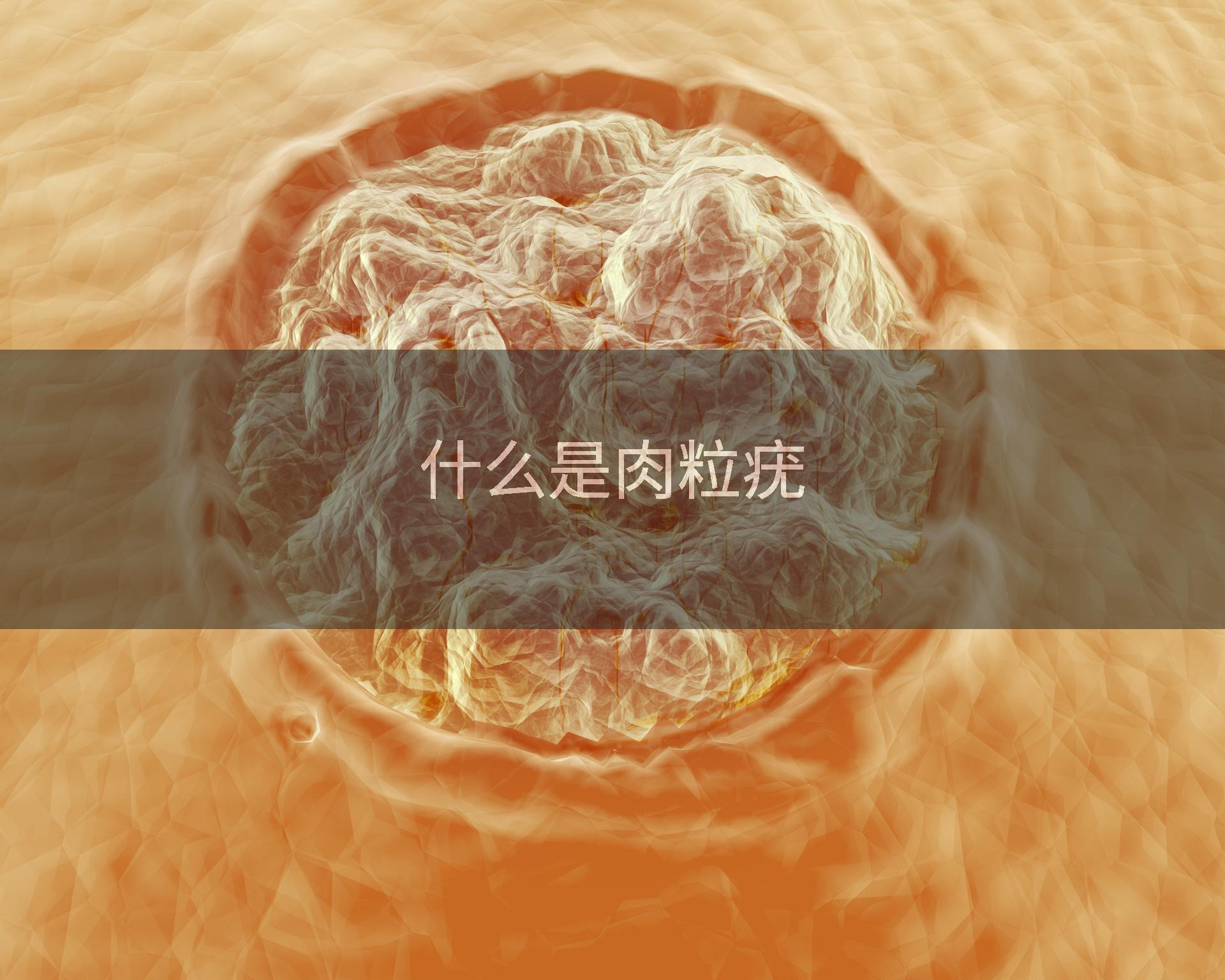 什么是肉粒疣