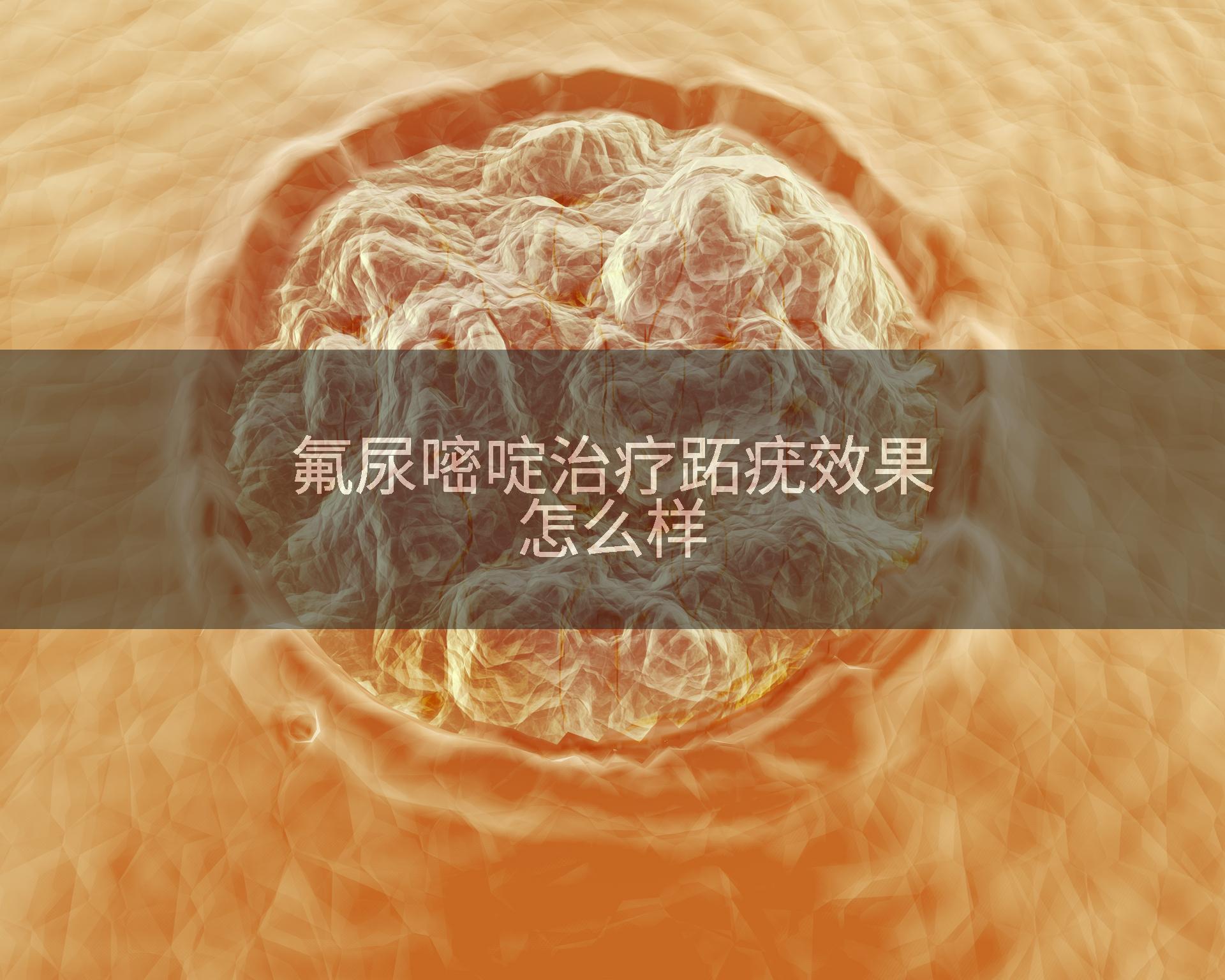 氟尿嘧啶治疗跖疣效果怎么样