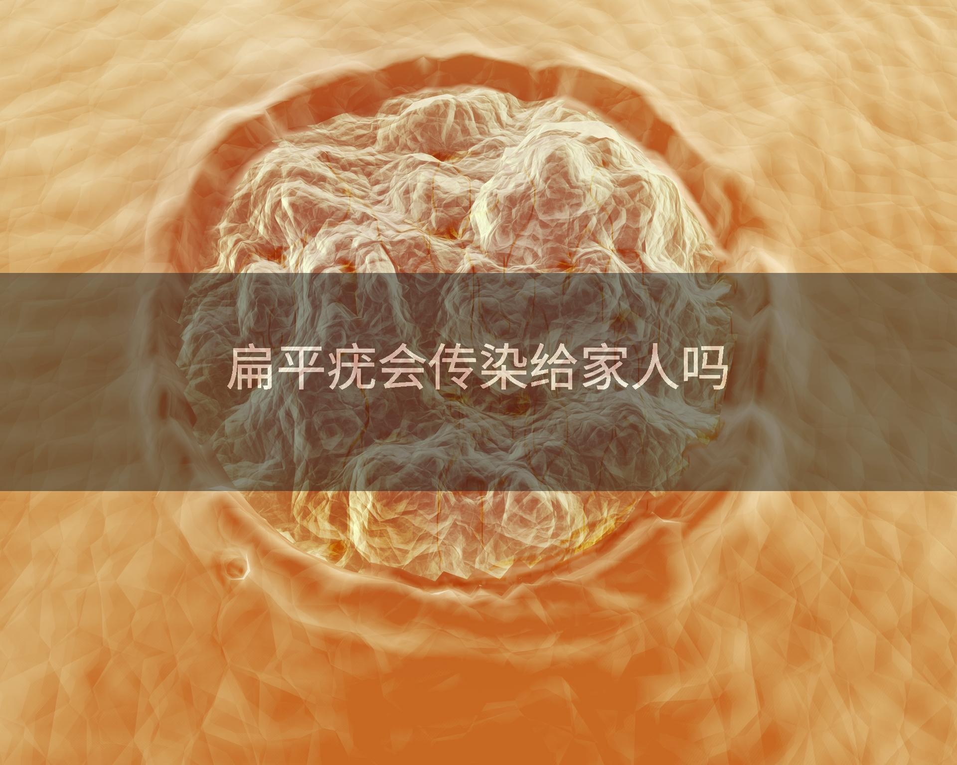 扁平疣会传染给家人吗