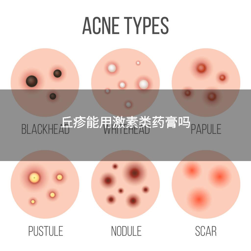 丘疹能用激素类药膏吗