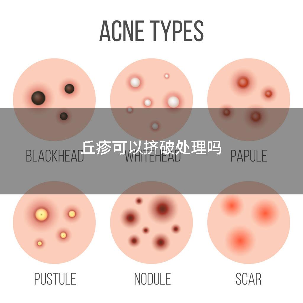 丘疹可以挤破处理吗