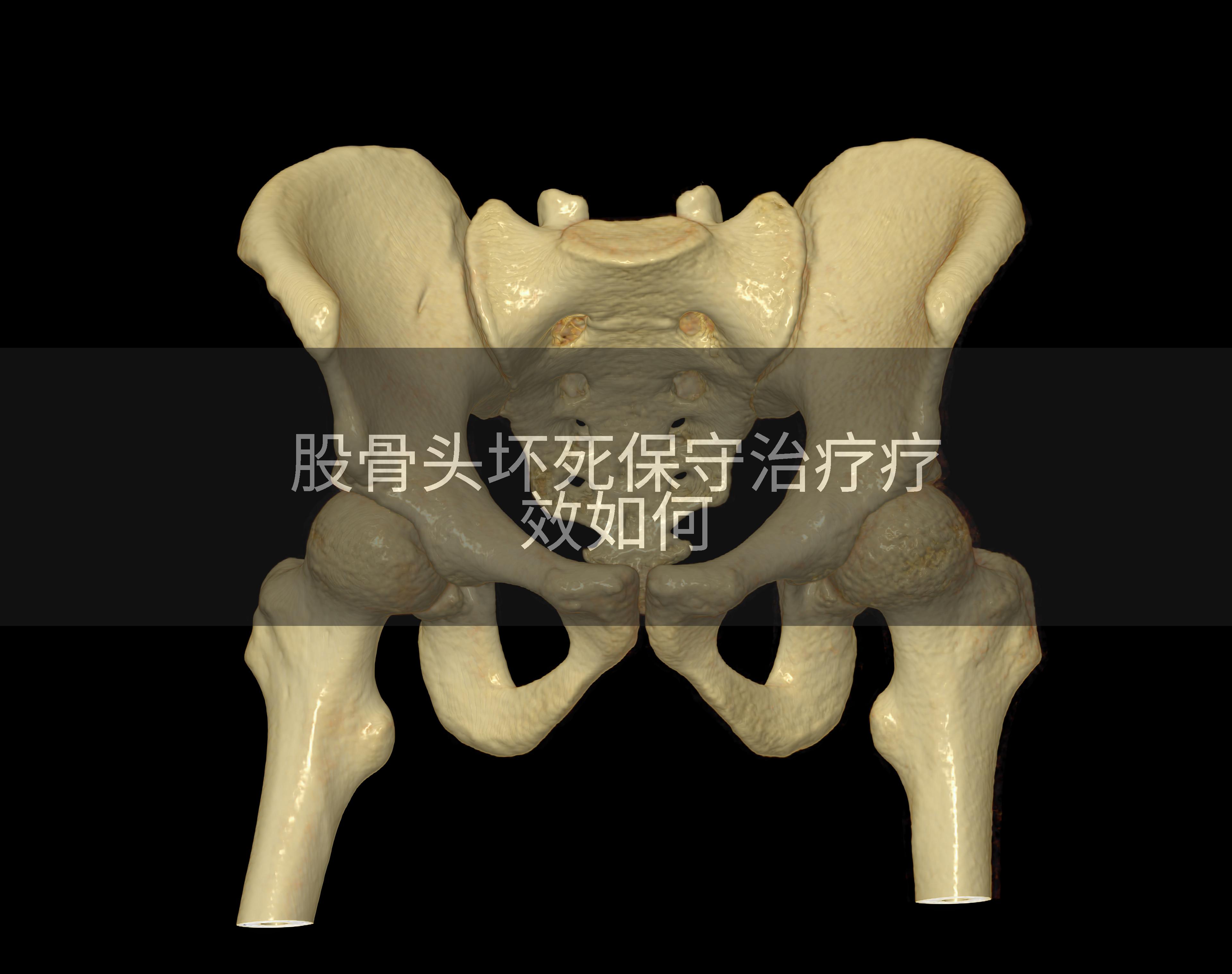 股骨头坏死保守治疗疗效如何