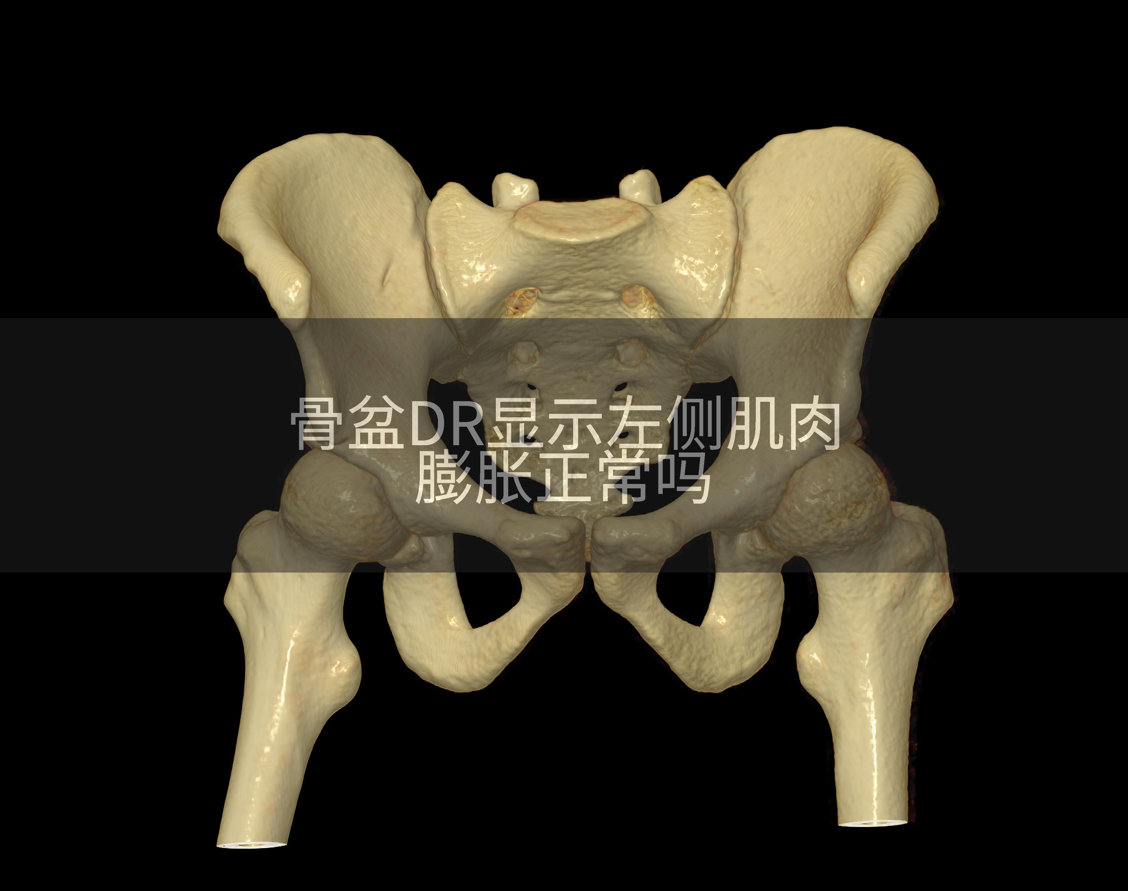 骨盆DR显示左侧肌肉膨胀正常吗