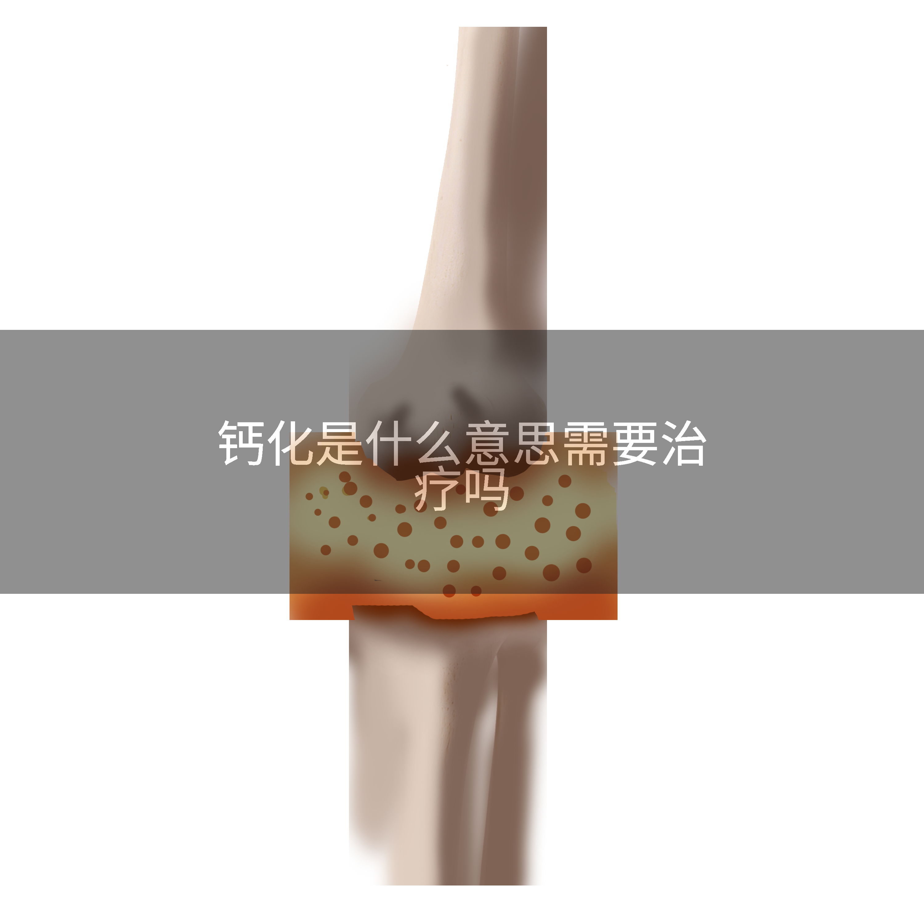 钙化是什么意思需要治疗吗