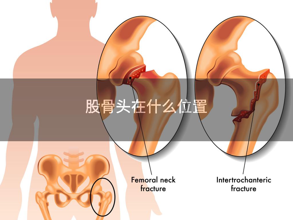 股骨头在什么位置