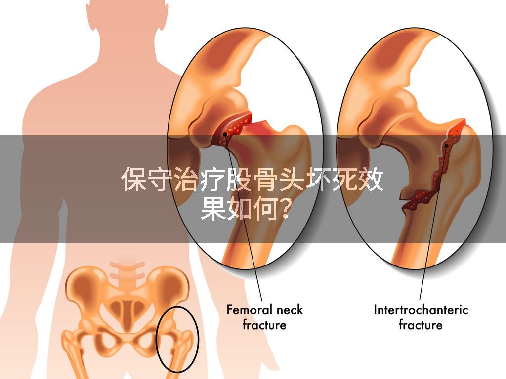 保守治疗股骨头坏死效果如何？