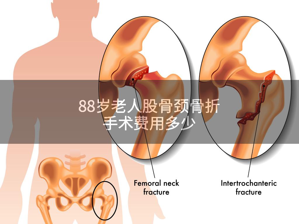 88岁老人股骨颈骨折手术费用多少