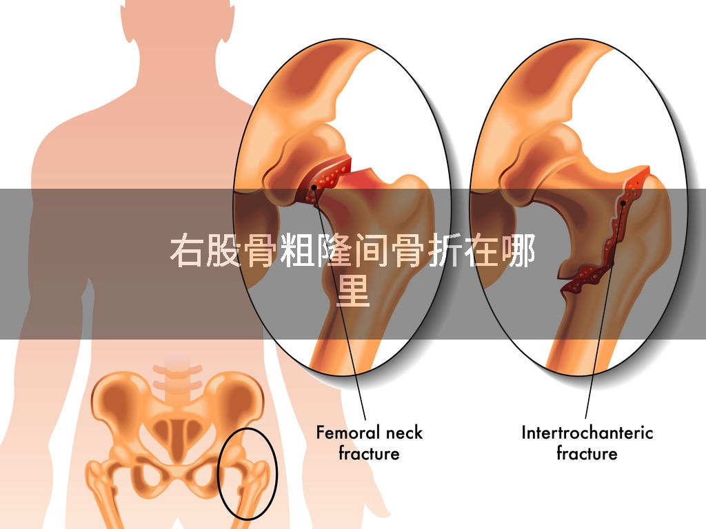 右股骨粗隆间骨折在哪里
