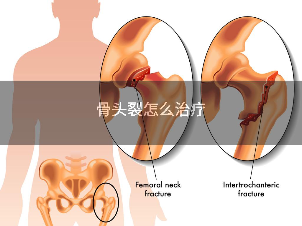 骨头裂怎么治疗